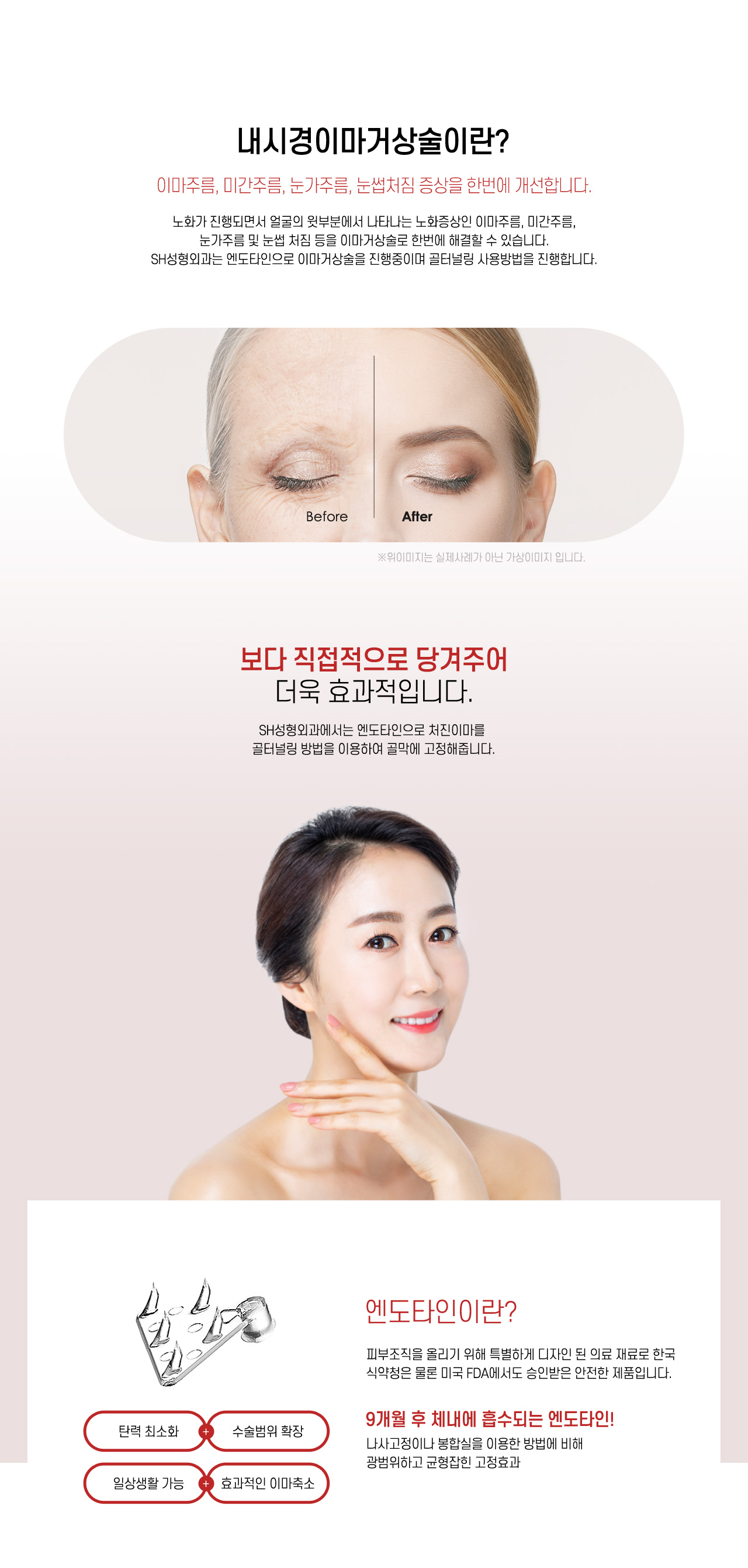 내시경이마거상술이란?