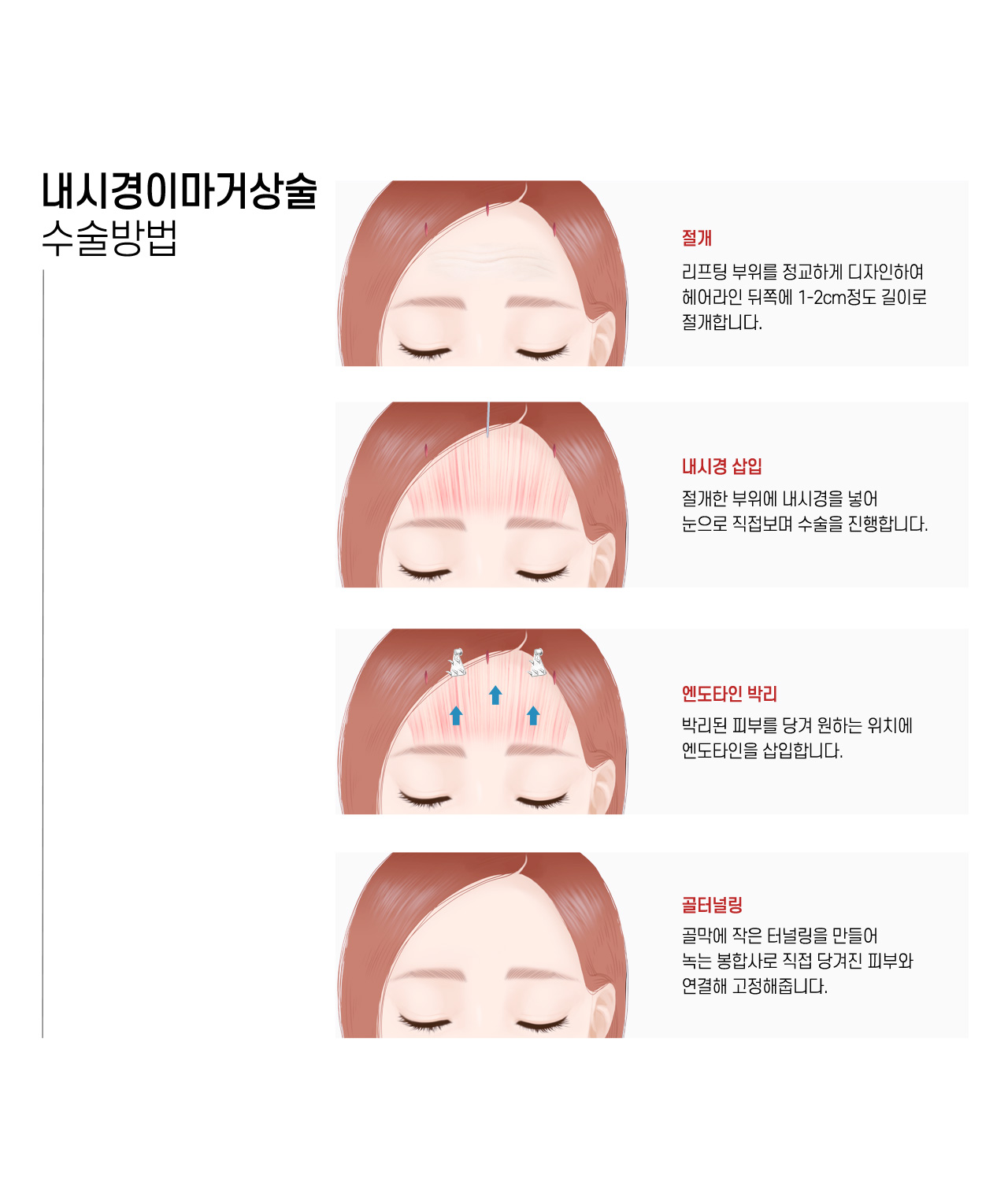 내시경이마거상술 수술방법