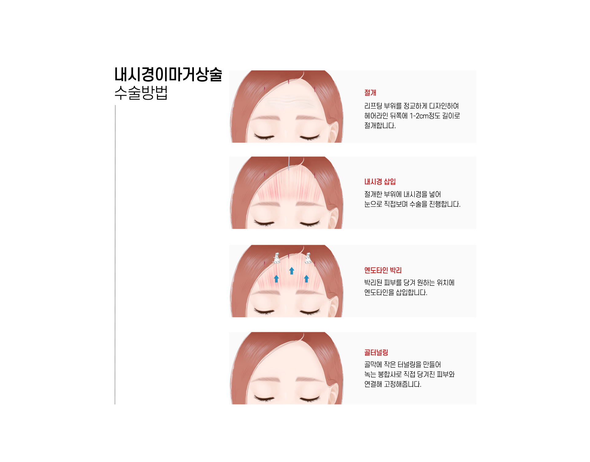 내시경이마거상술 수술방법