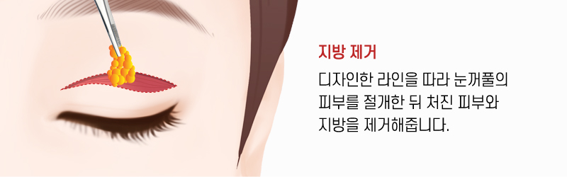 상안검 수술방법