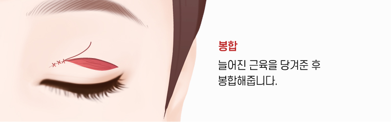 상안검 수술방법