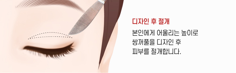 상안검 수술방법