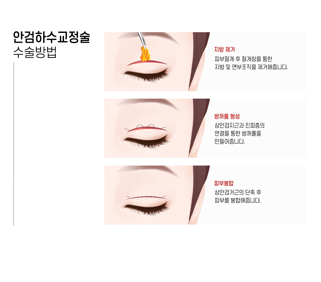 안검하수교정술 수술방법