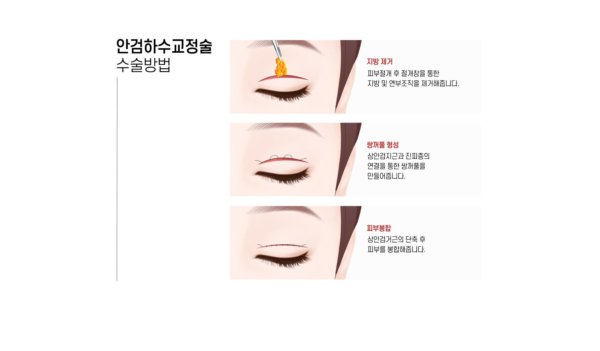 안검하수교정술 수술방법