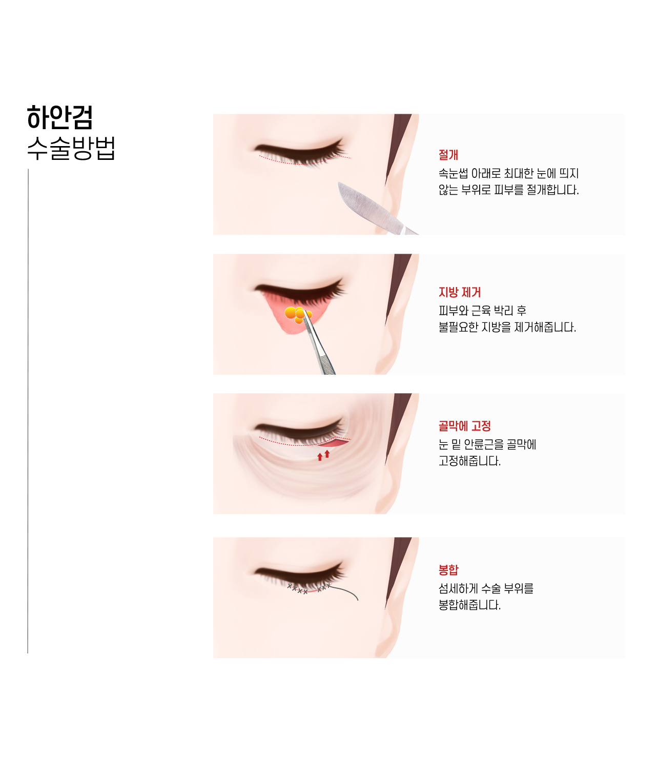 하안검 수술방법