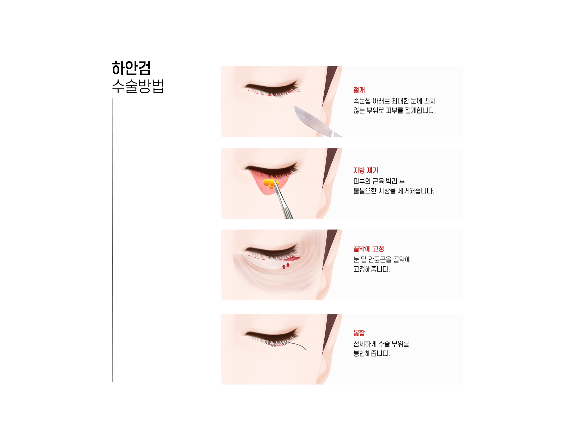 하안검 수술방법
