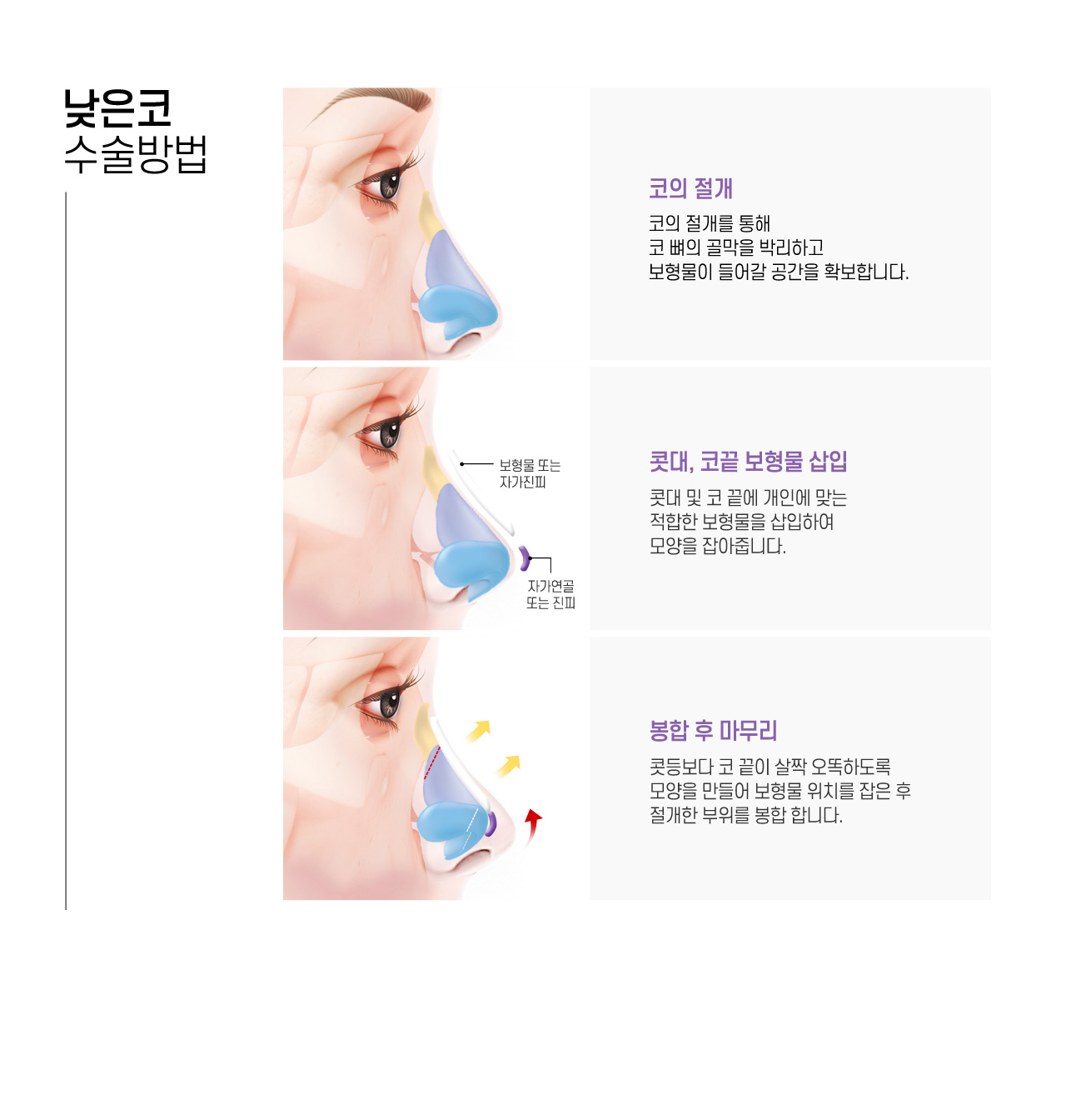 낮은코 수술방법