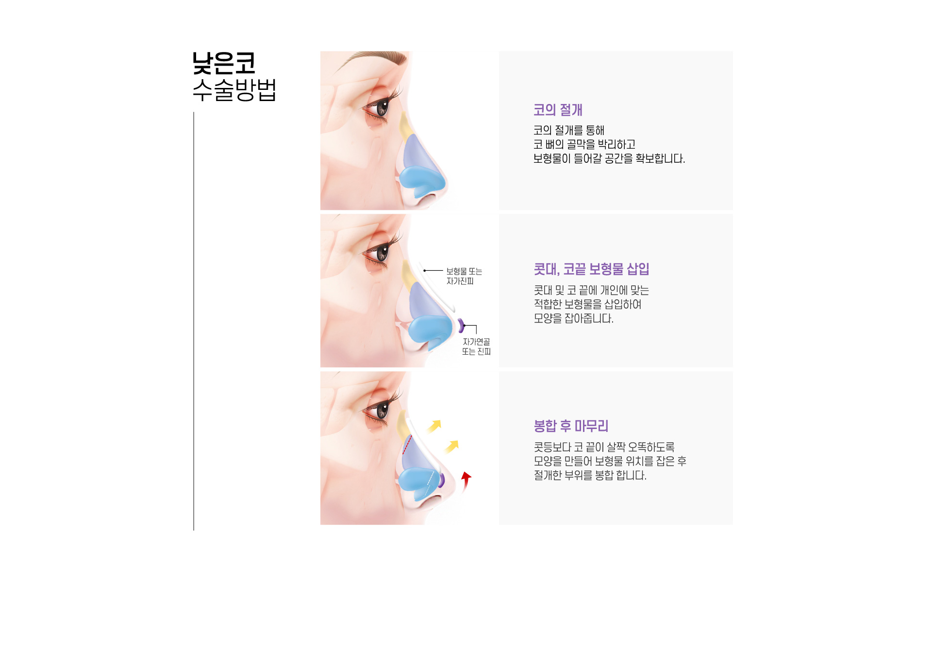 낮은코 수술방법