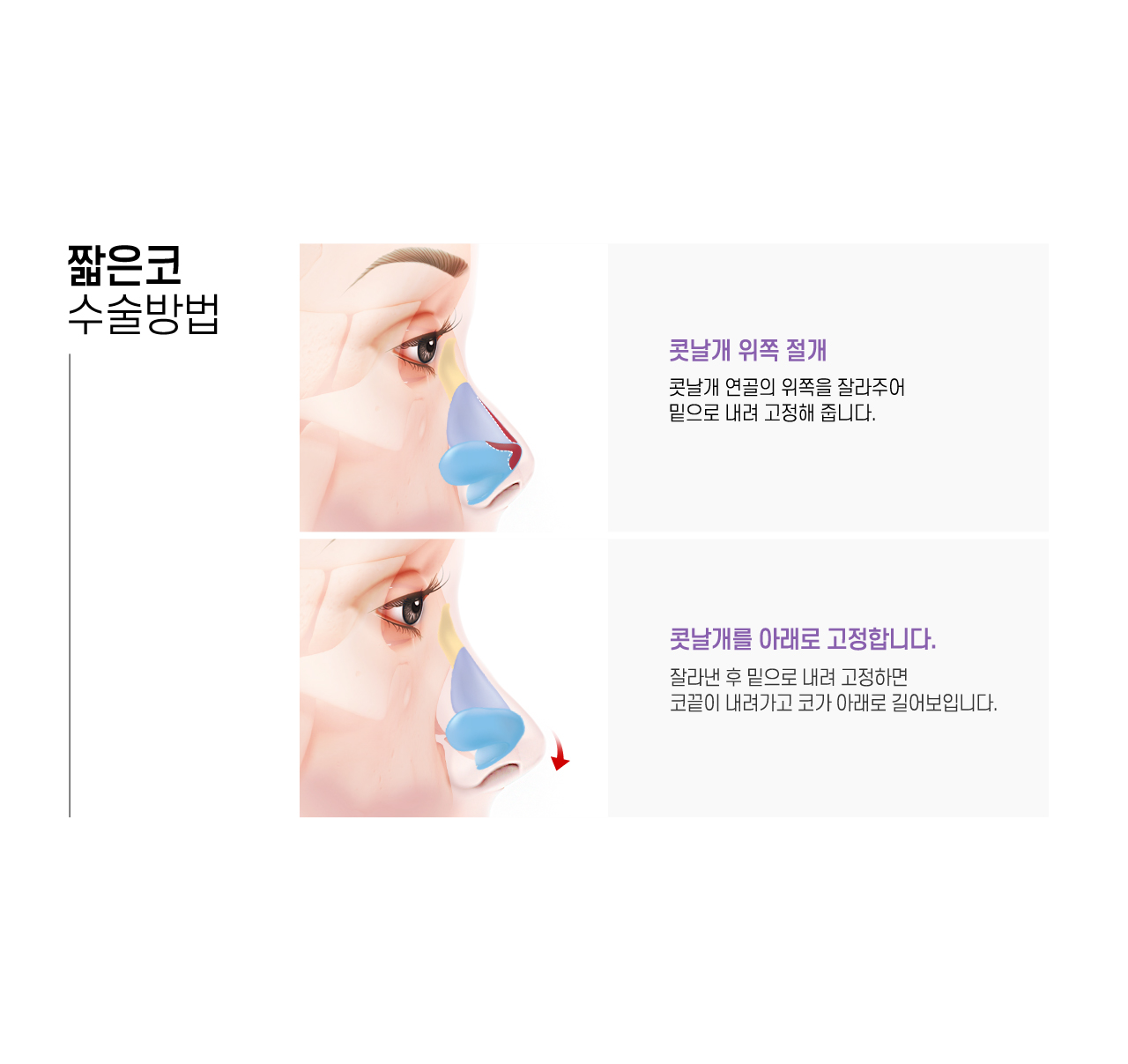 짧은코 수술방법