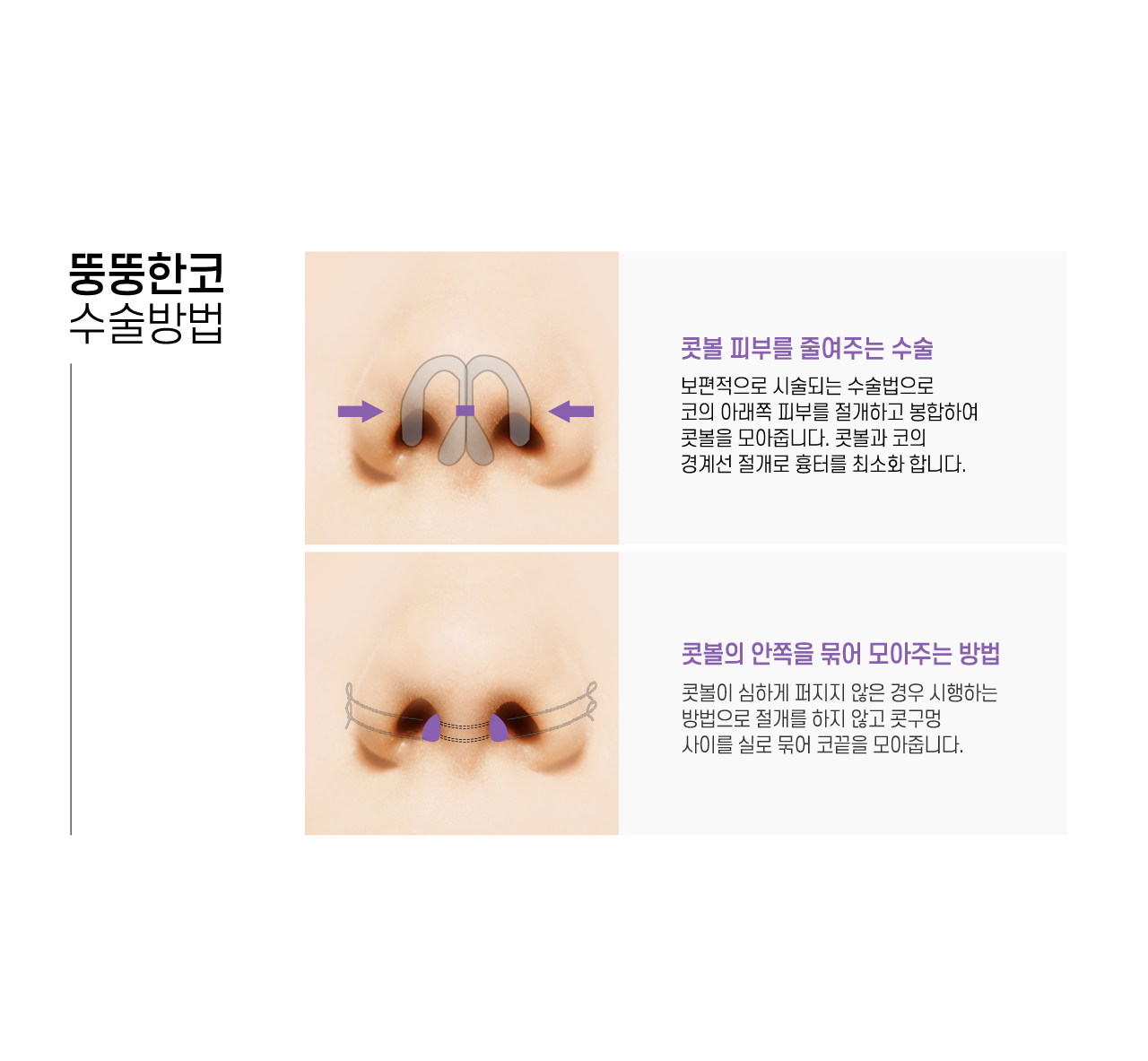 뚱뚱한코 수술방법