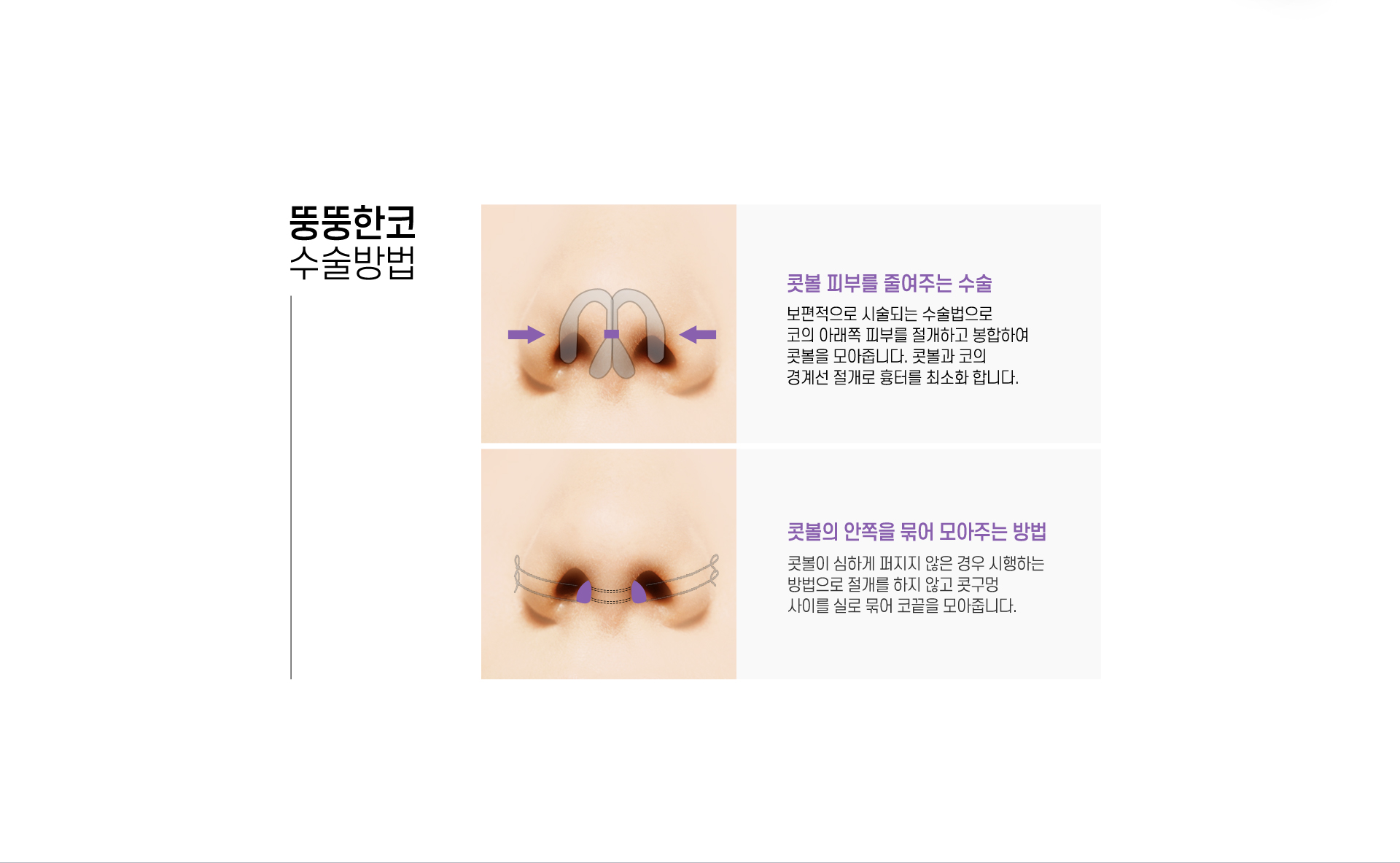 뚱뚱한코 수술방법