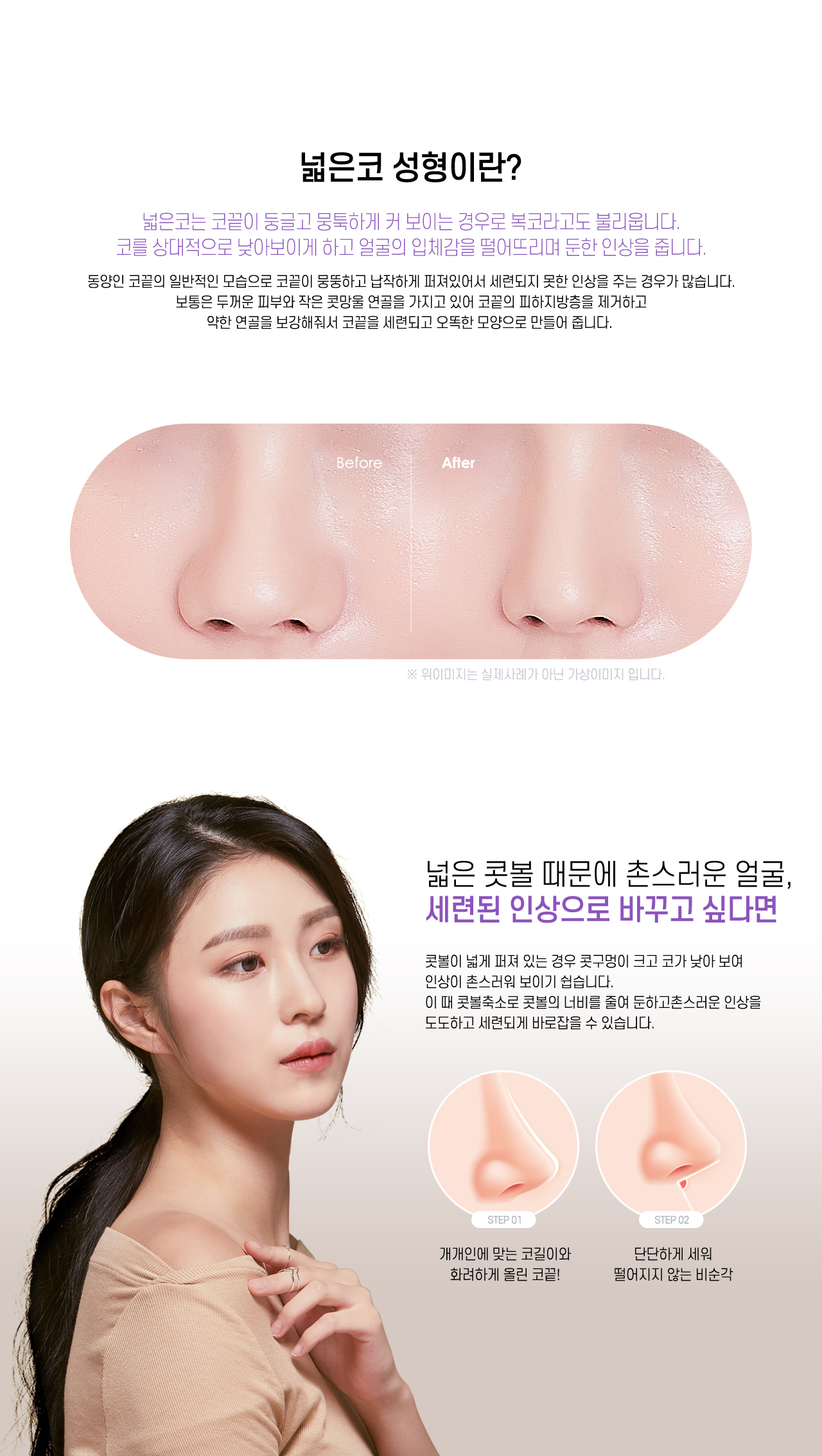 넓은코 수술이란?