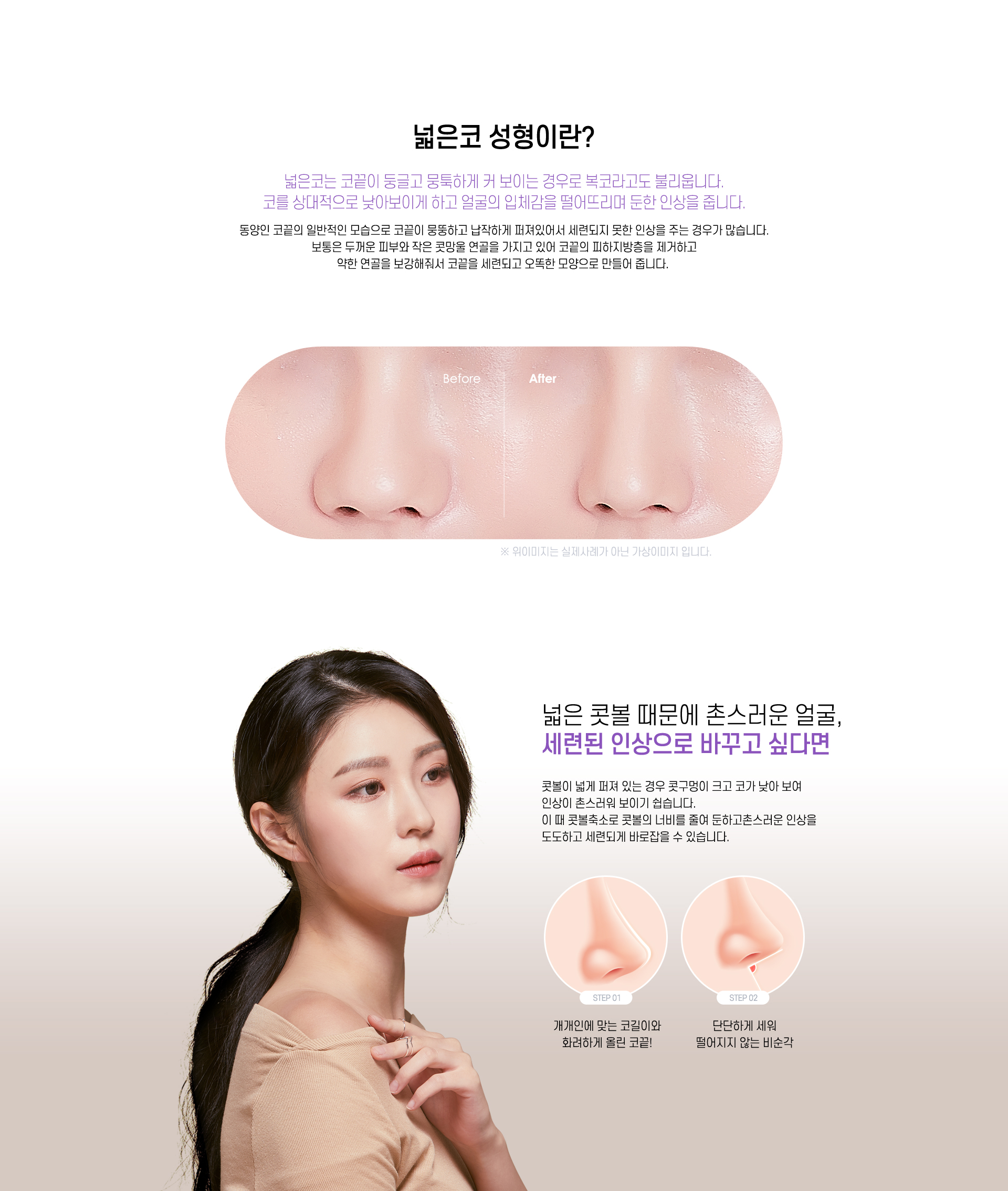 넓은코 수술이란?