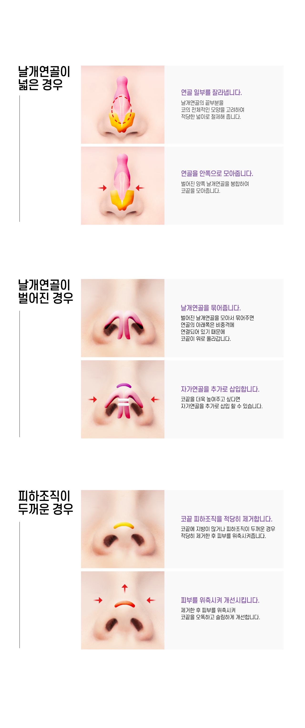 넓은코 수술방법