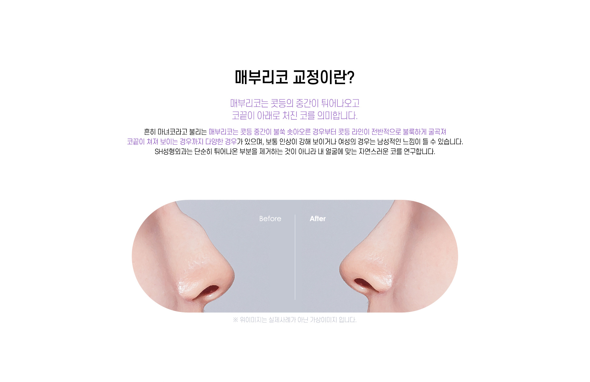 매부리코 수술이란?