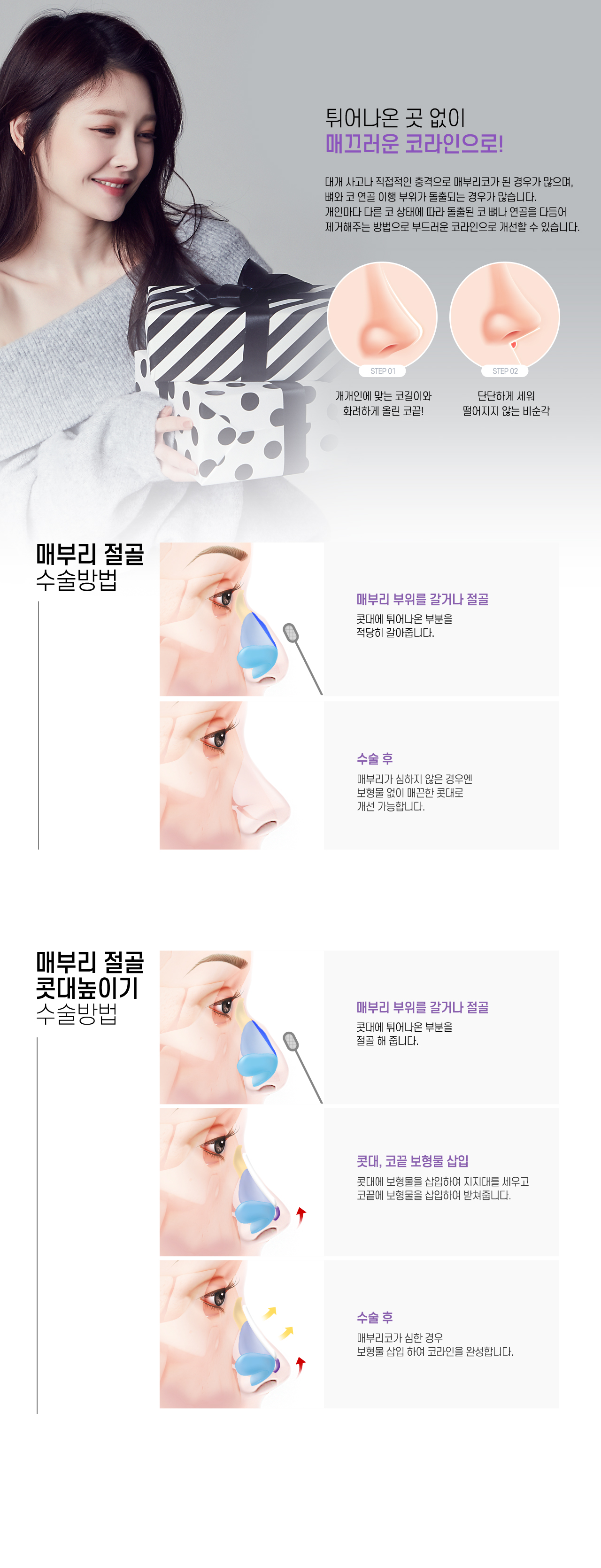 매부리코 수술방법