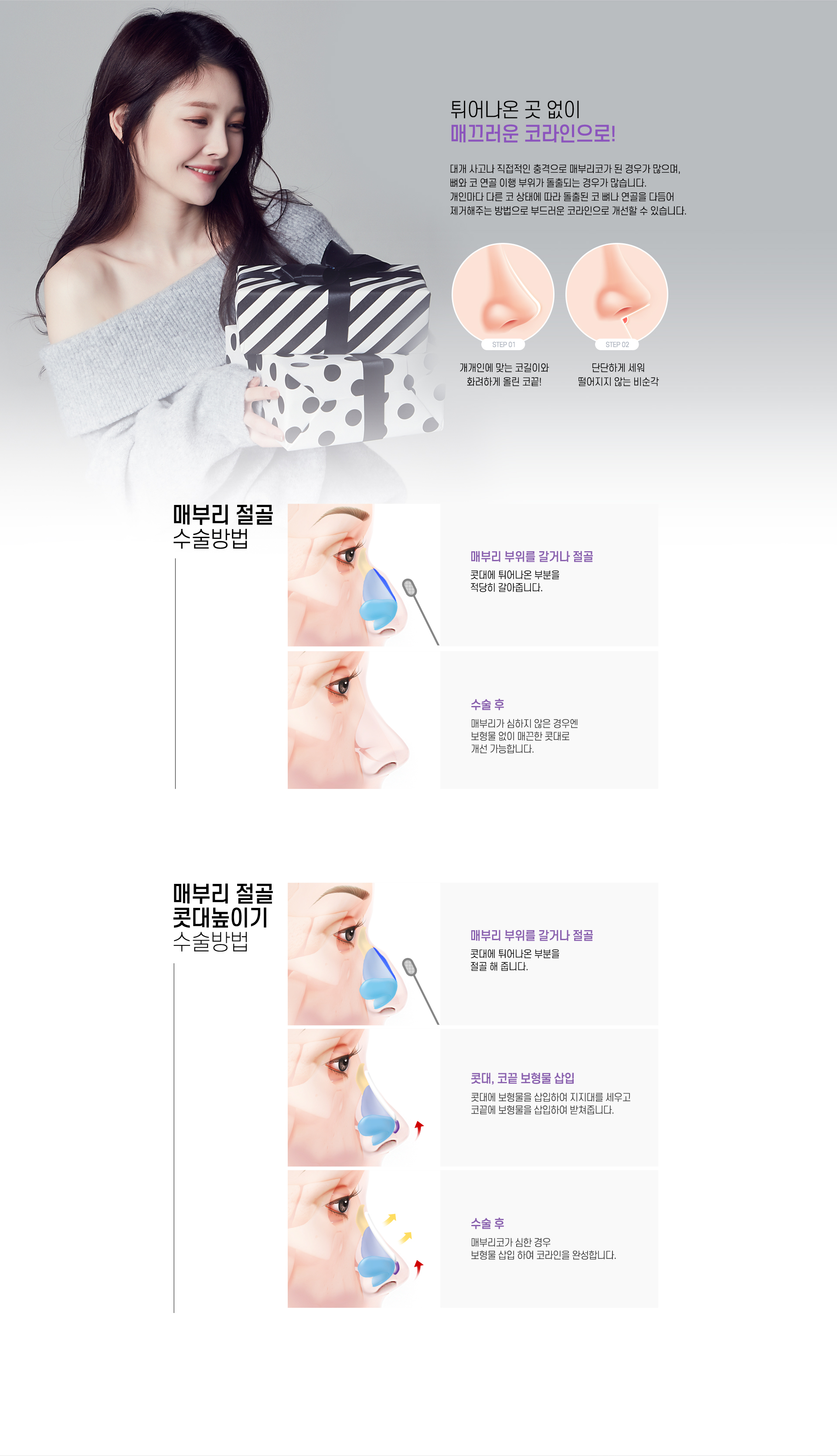 매부리코 수술방법