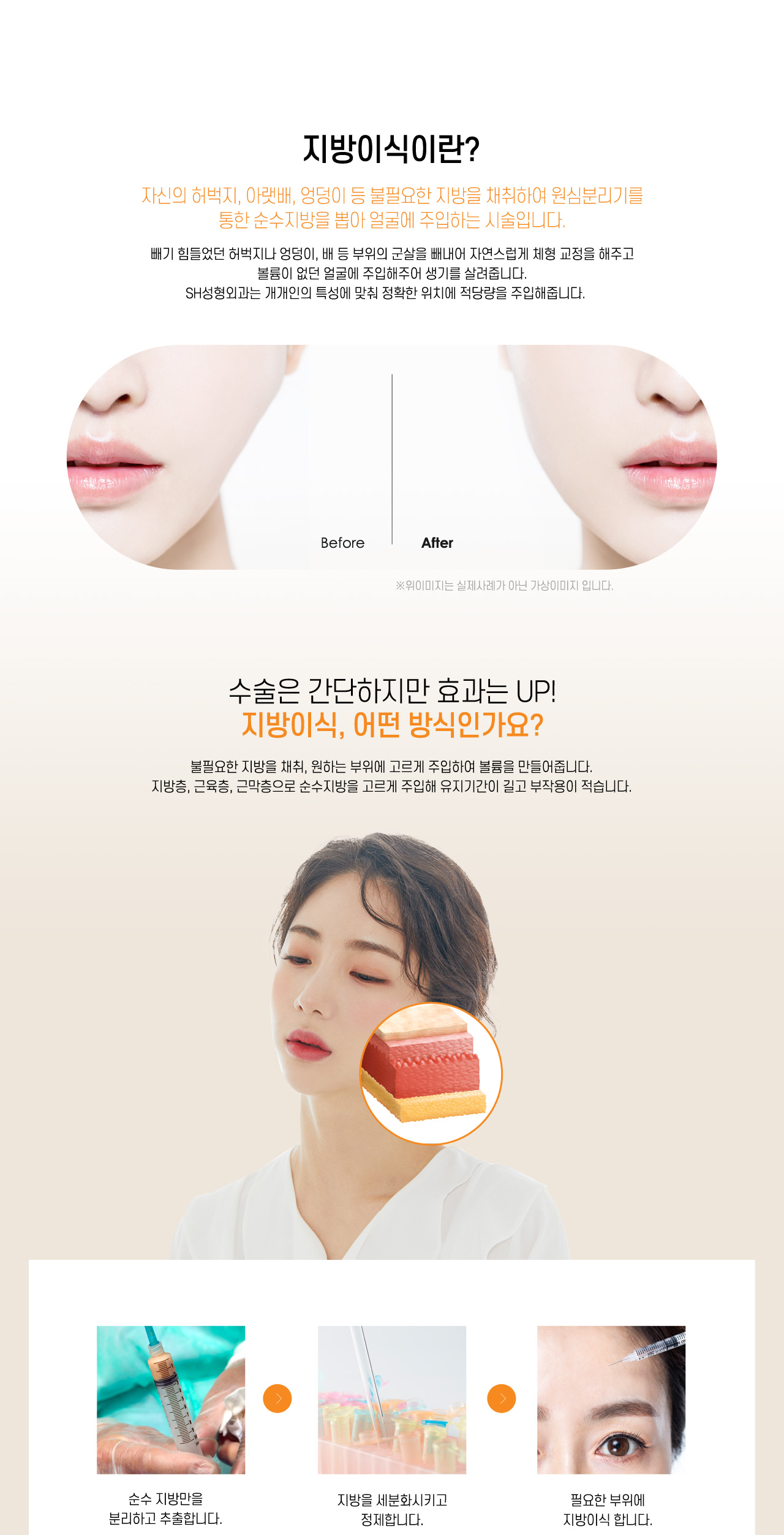 지방이식 이란?