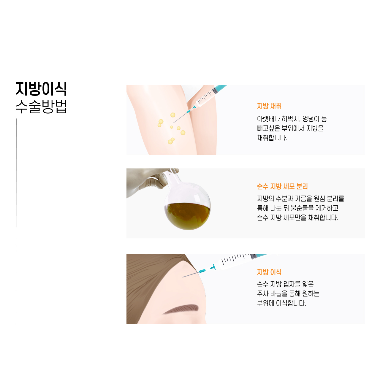 지방이식 수술방법