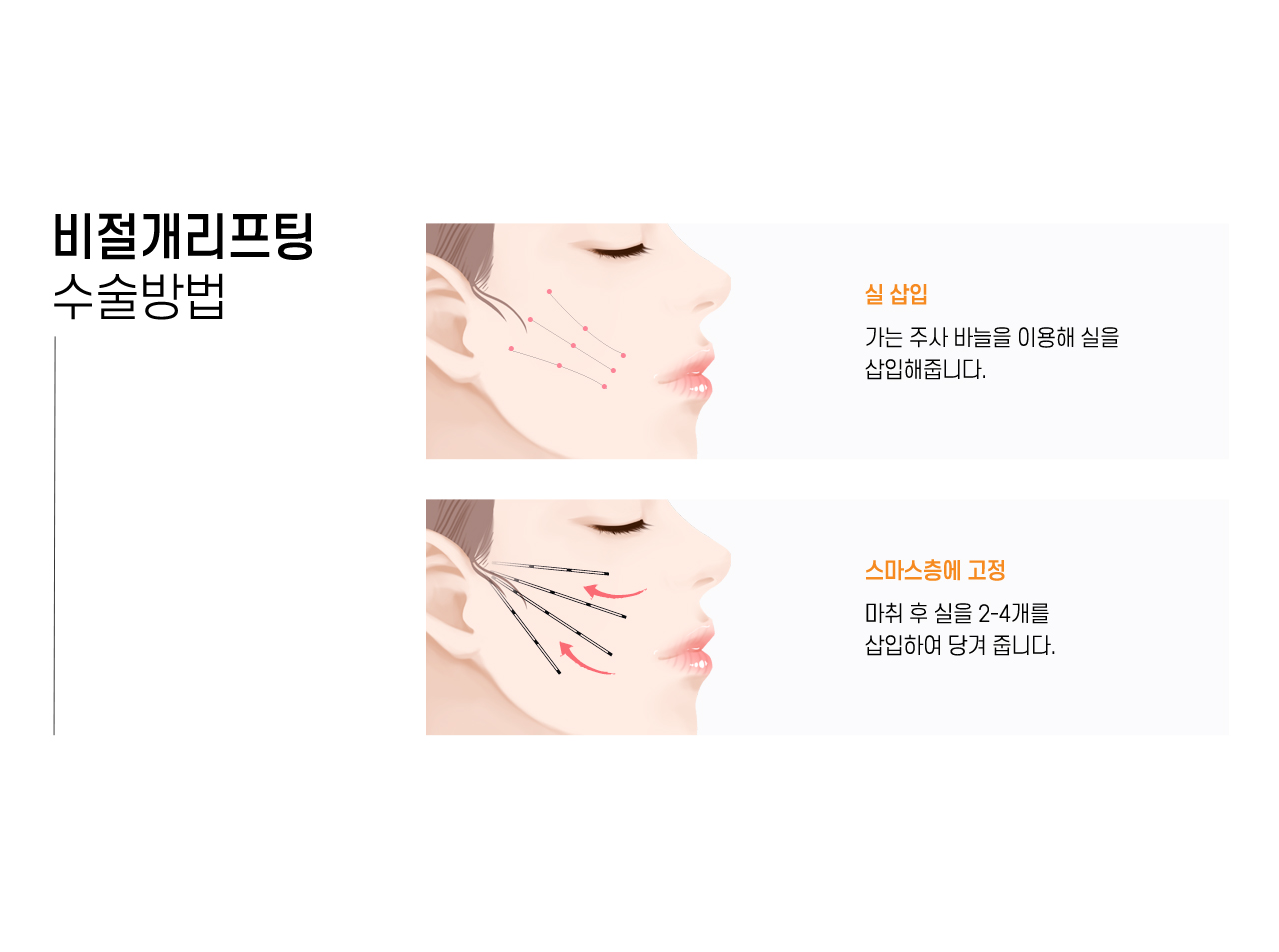 비절개리프팅 수술방법