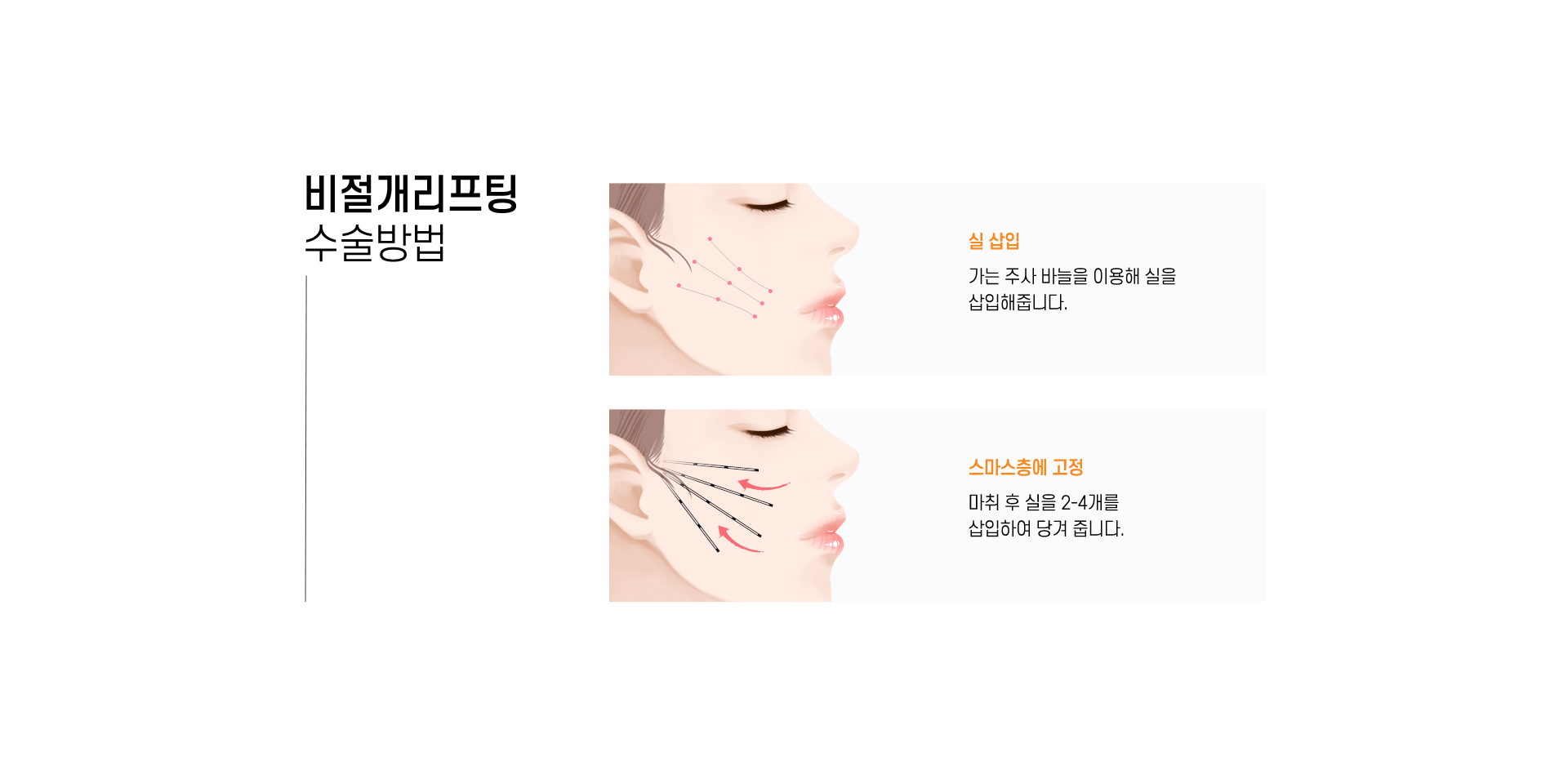 비절개리프팅 수술방법