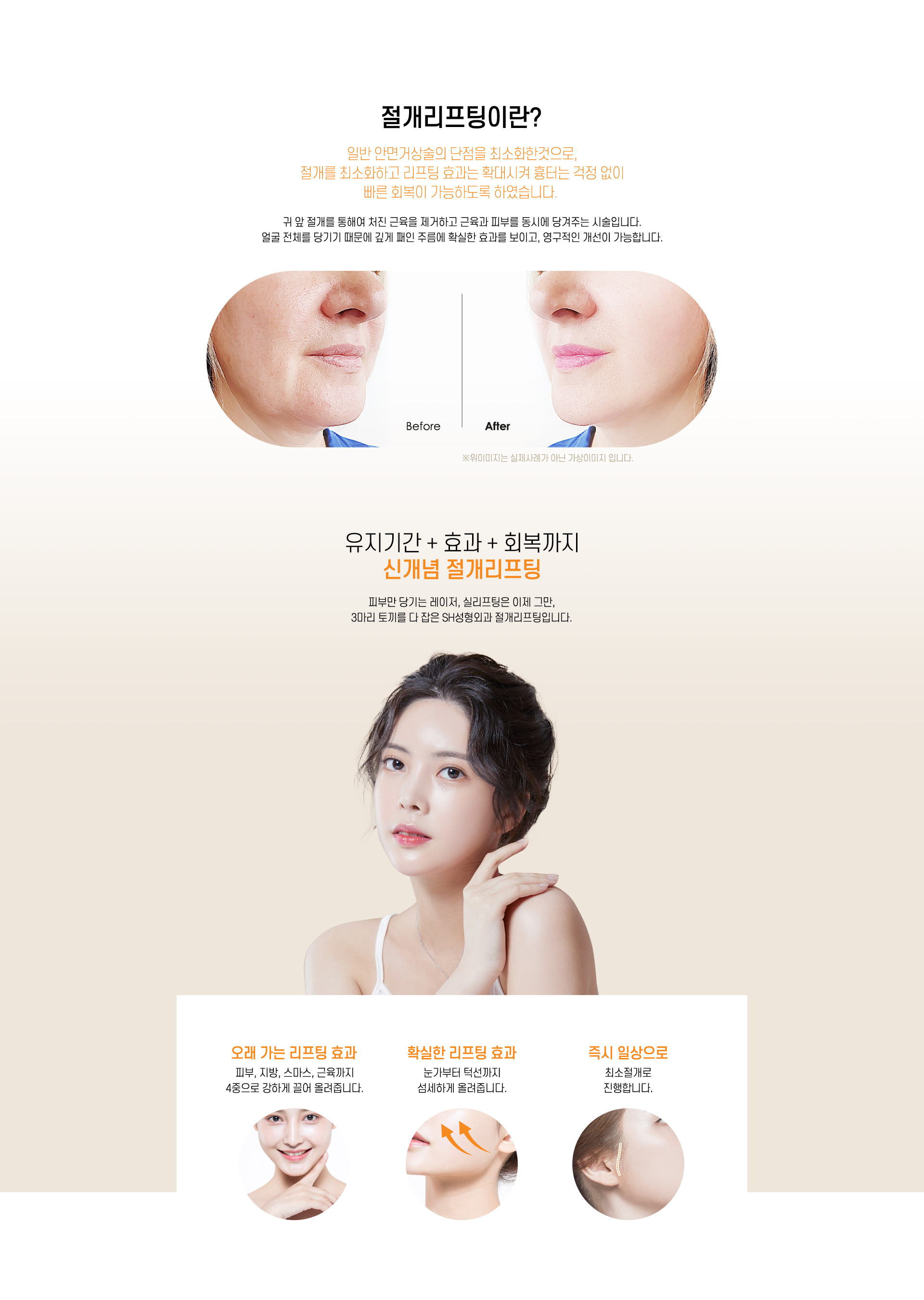 절개리프팅 이란?