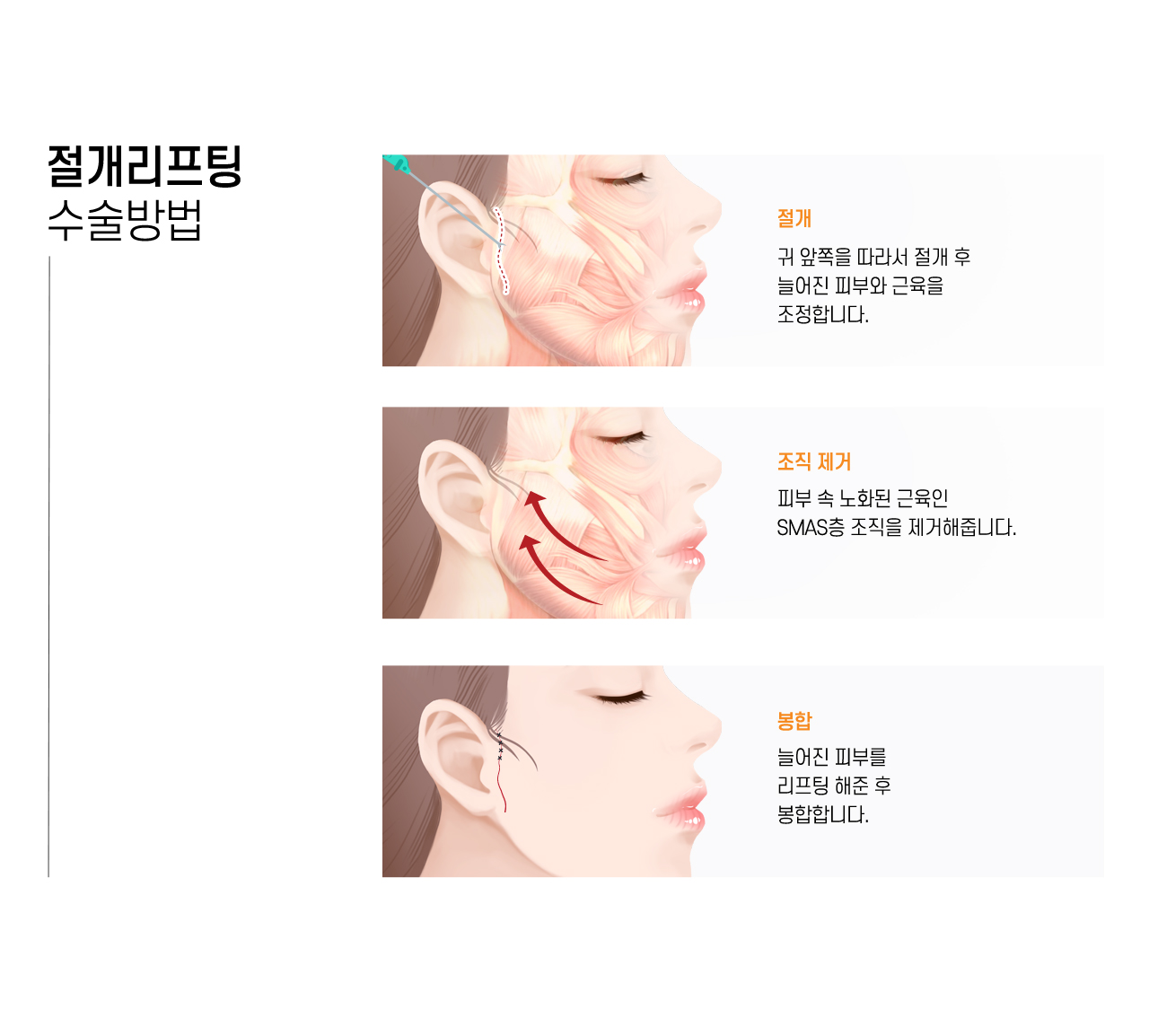 절개리프팅 수술방법