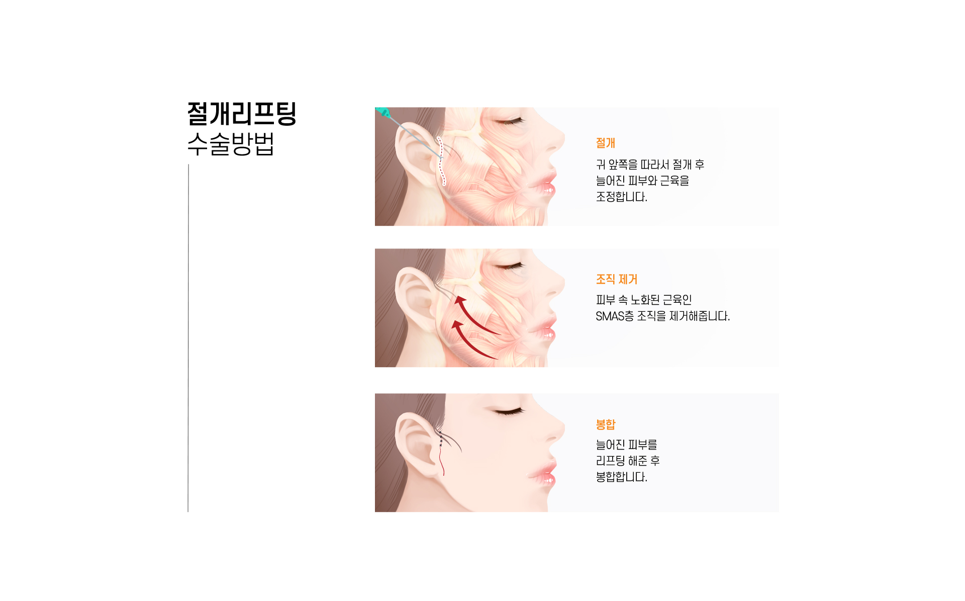 절개리프팅 수술방법