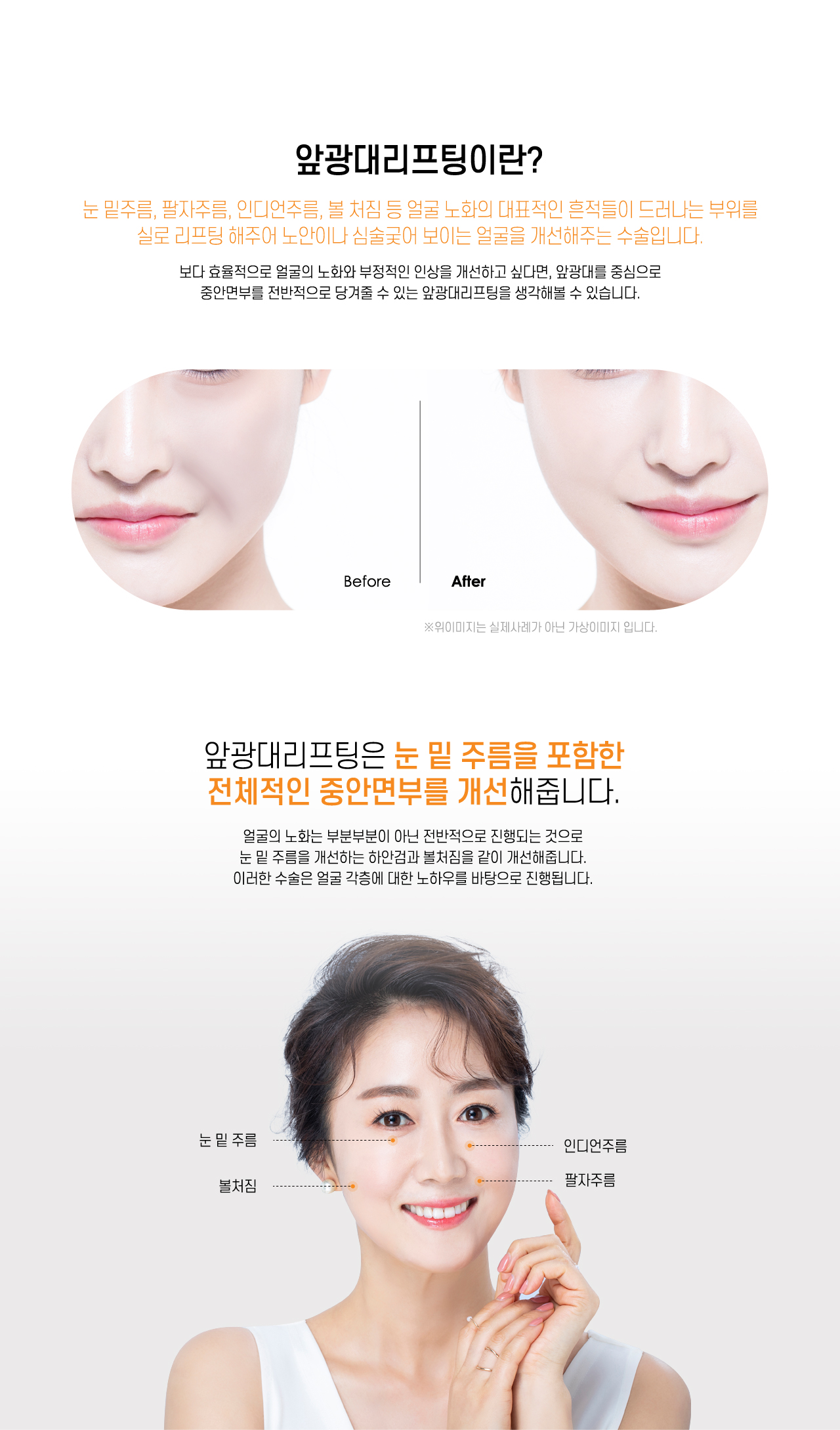 앞광대리프팅이란?