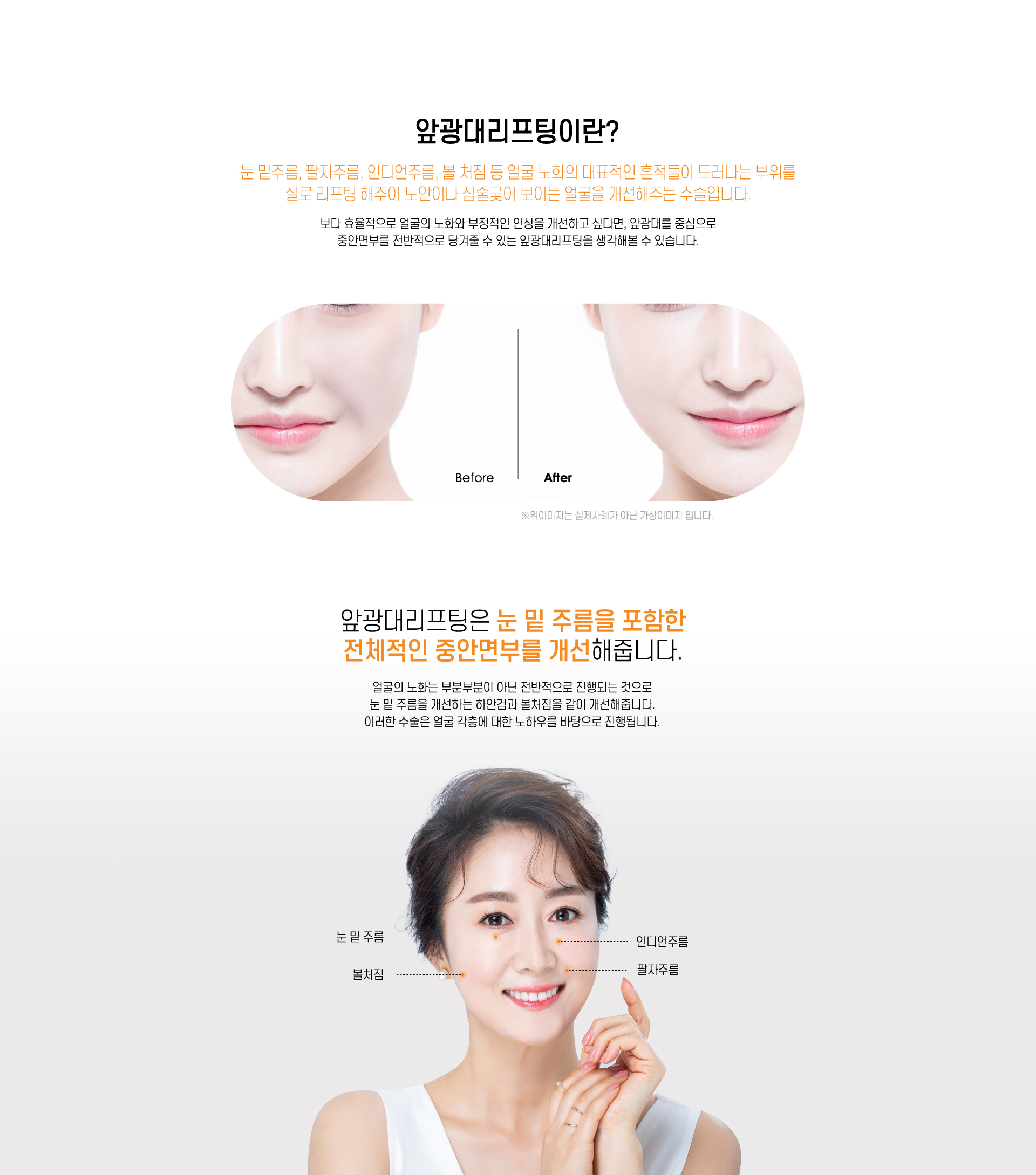 앞광대리프팅이란?