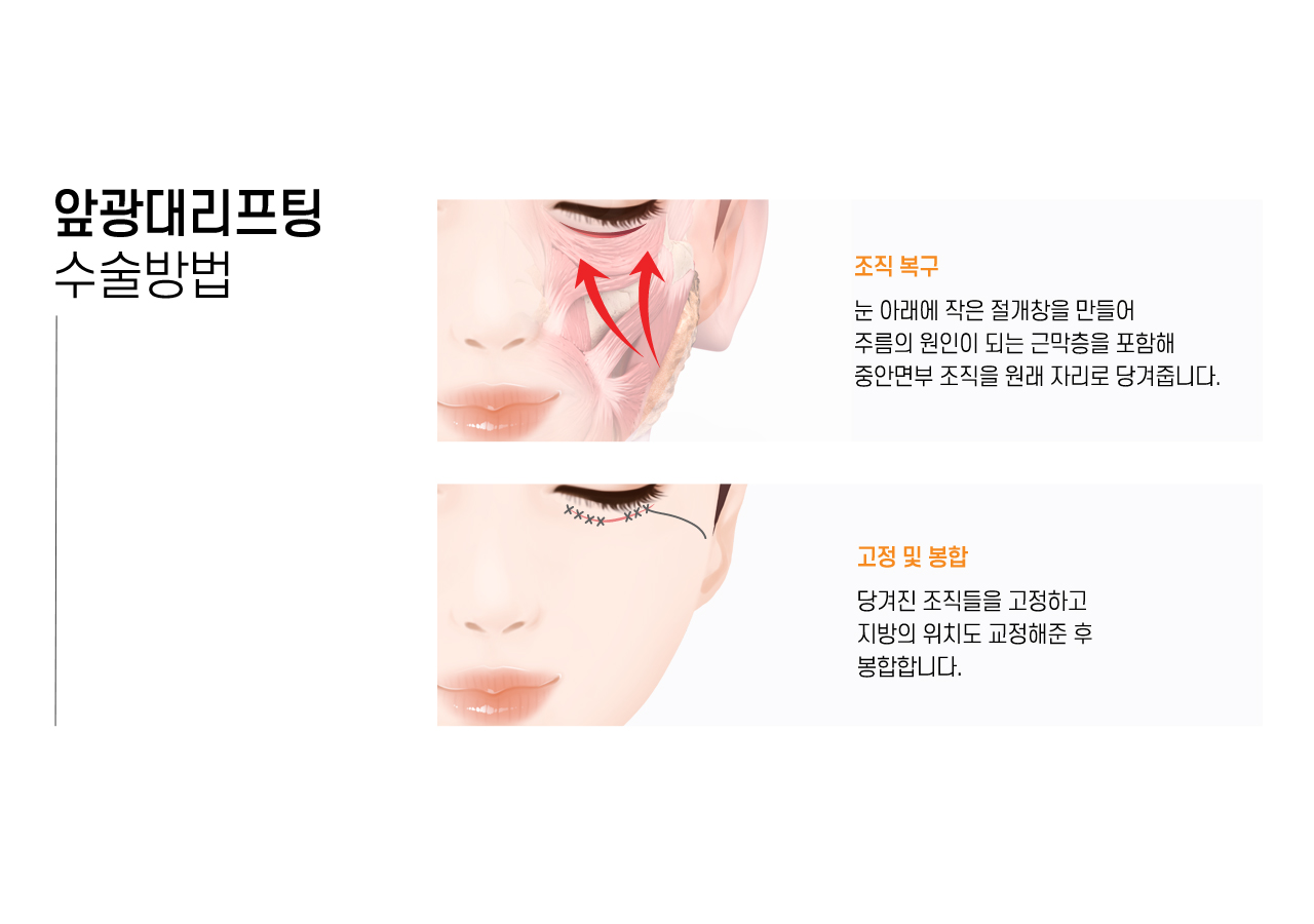 앞광대리프팅 수술방법