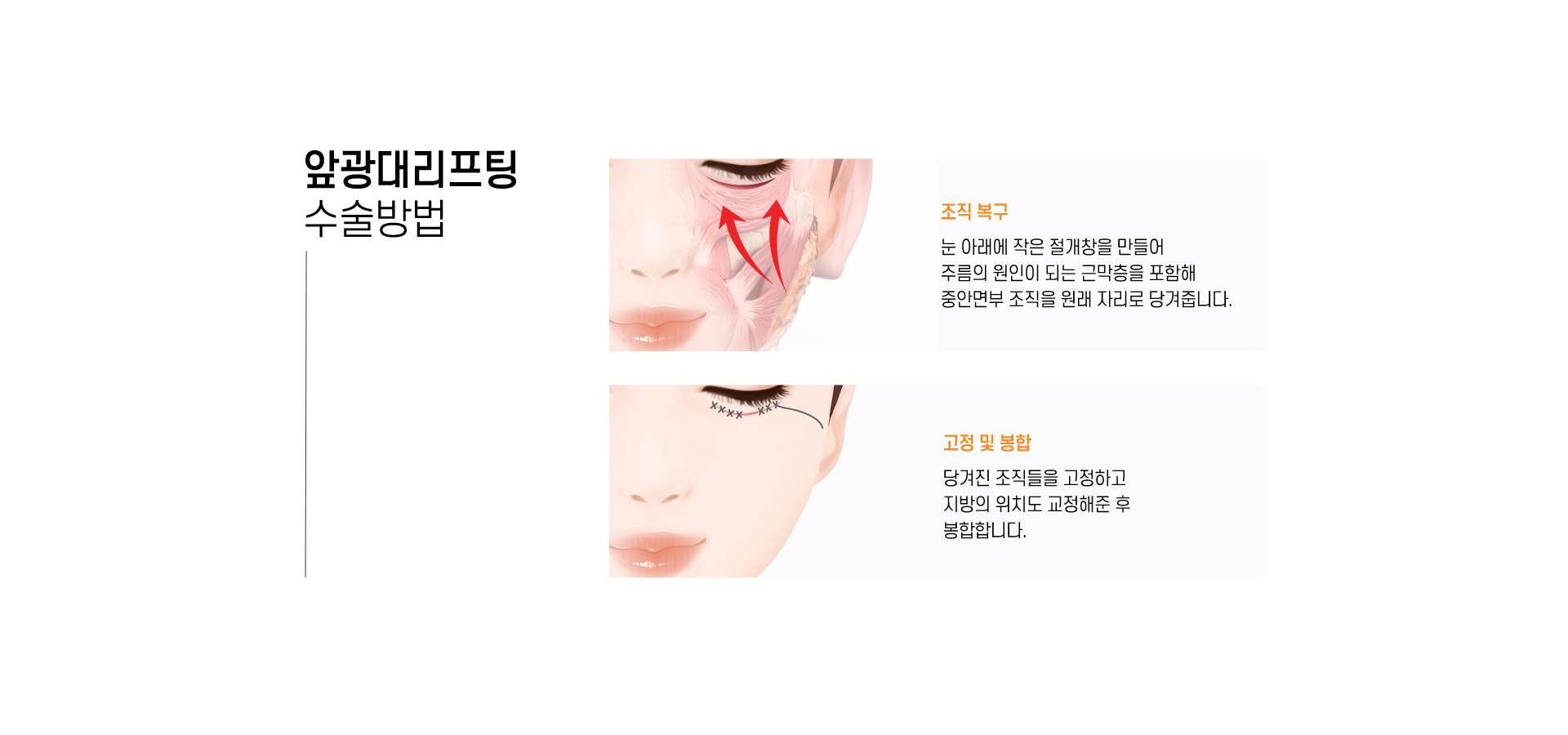 앞광대리프팅 수술방법
