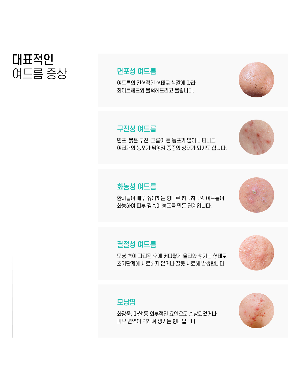 대표적인 여드름 증상
