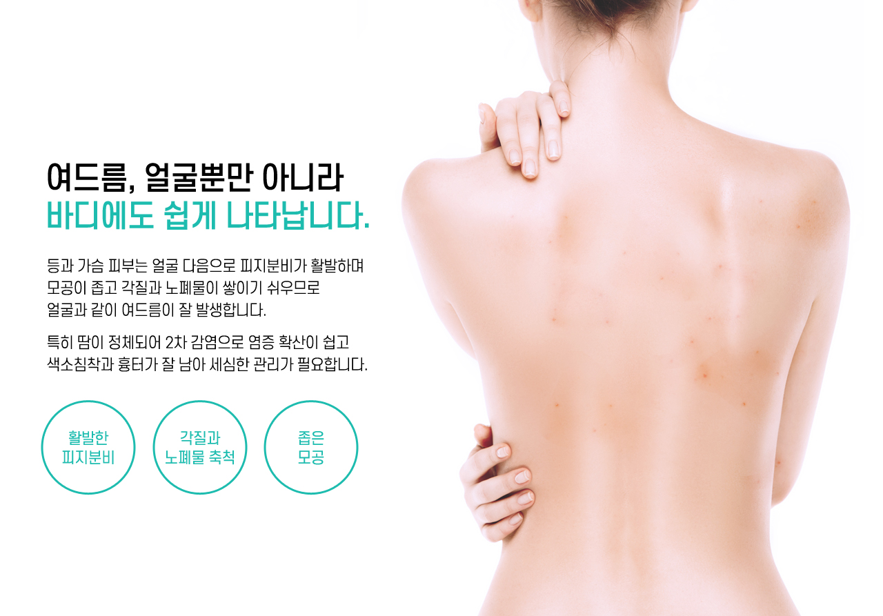 여드름, 얼굴뿐만 아니라 바디에도