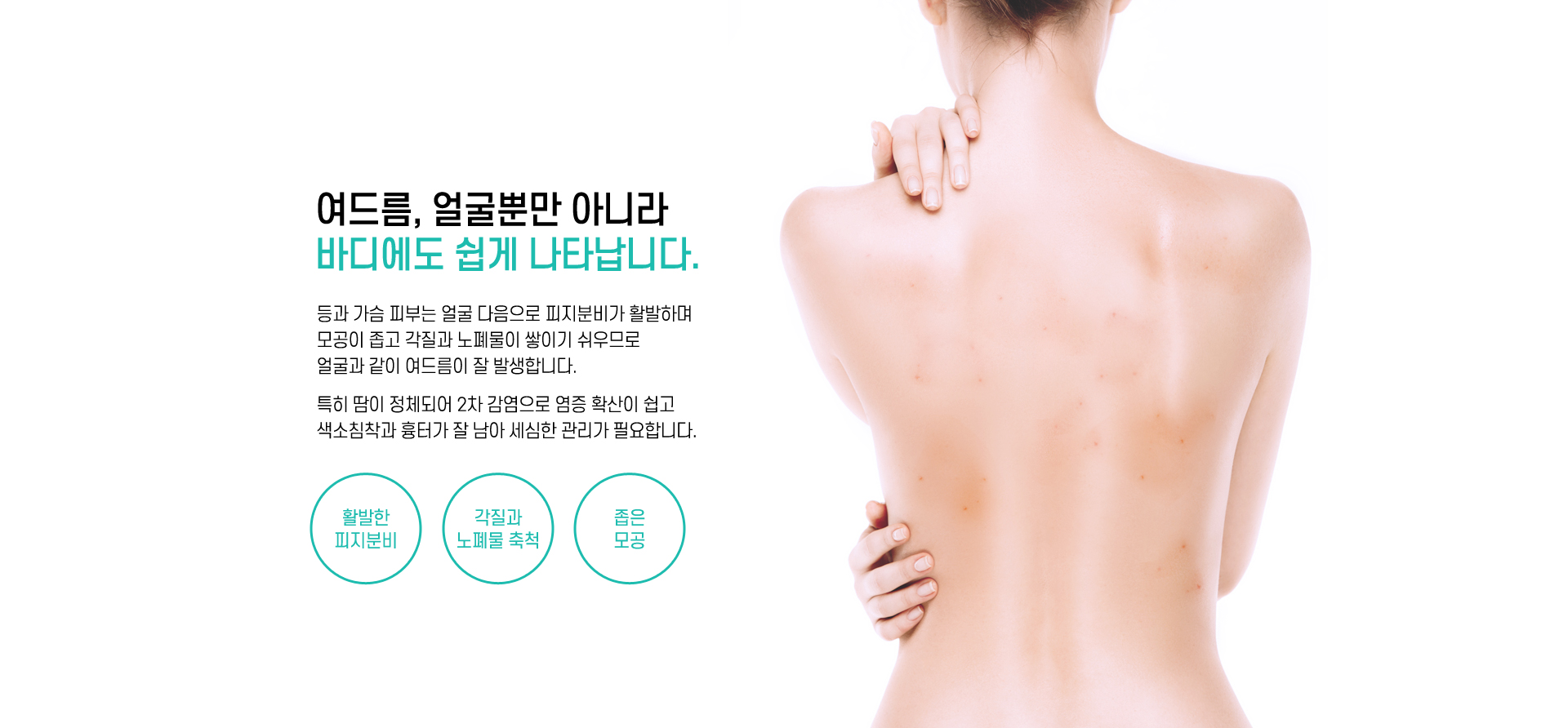 여드름, 얼굴뿐만 아니라 바디에도
