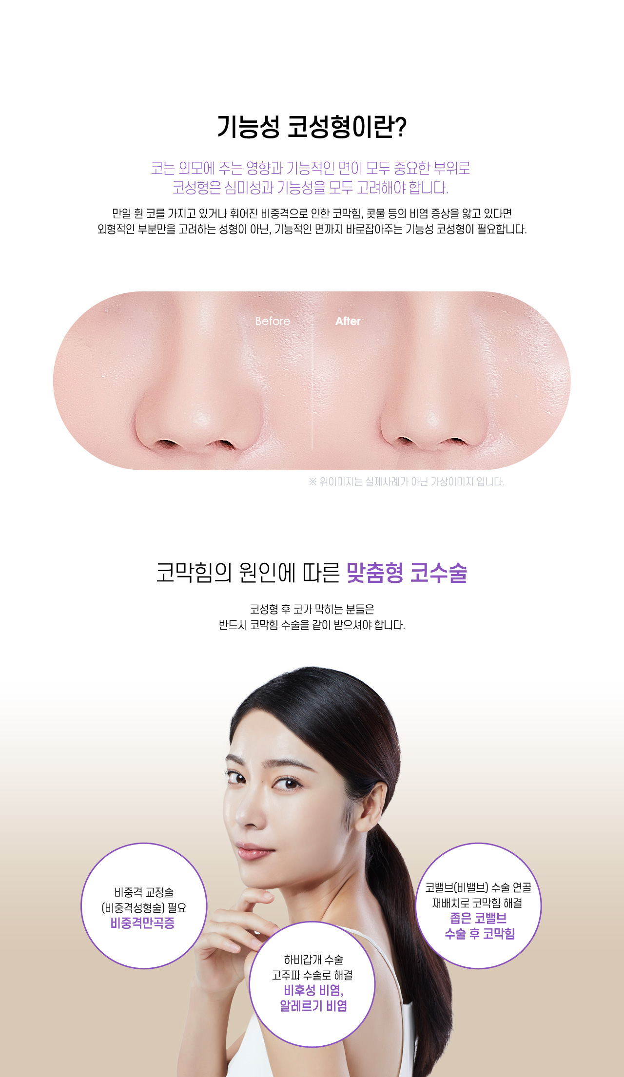 기능성코성형이란?