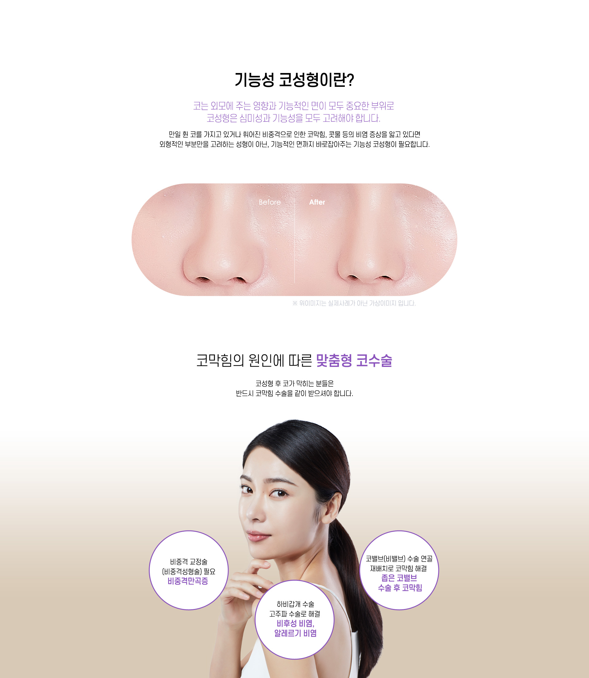 기능성코성형이란?