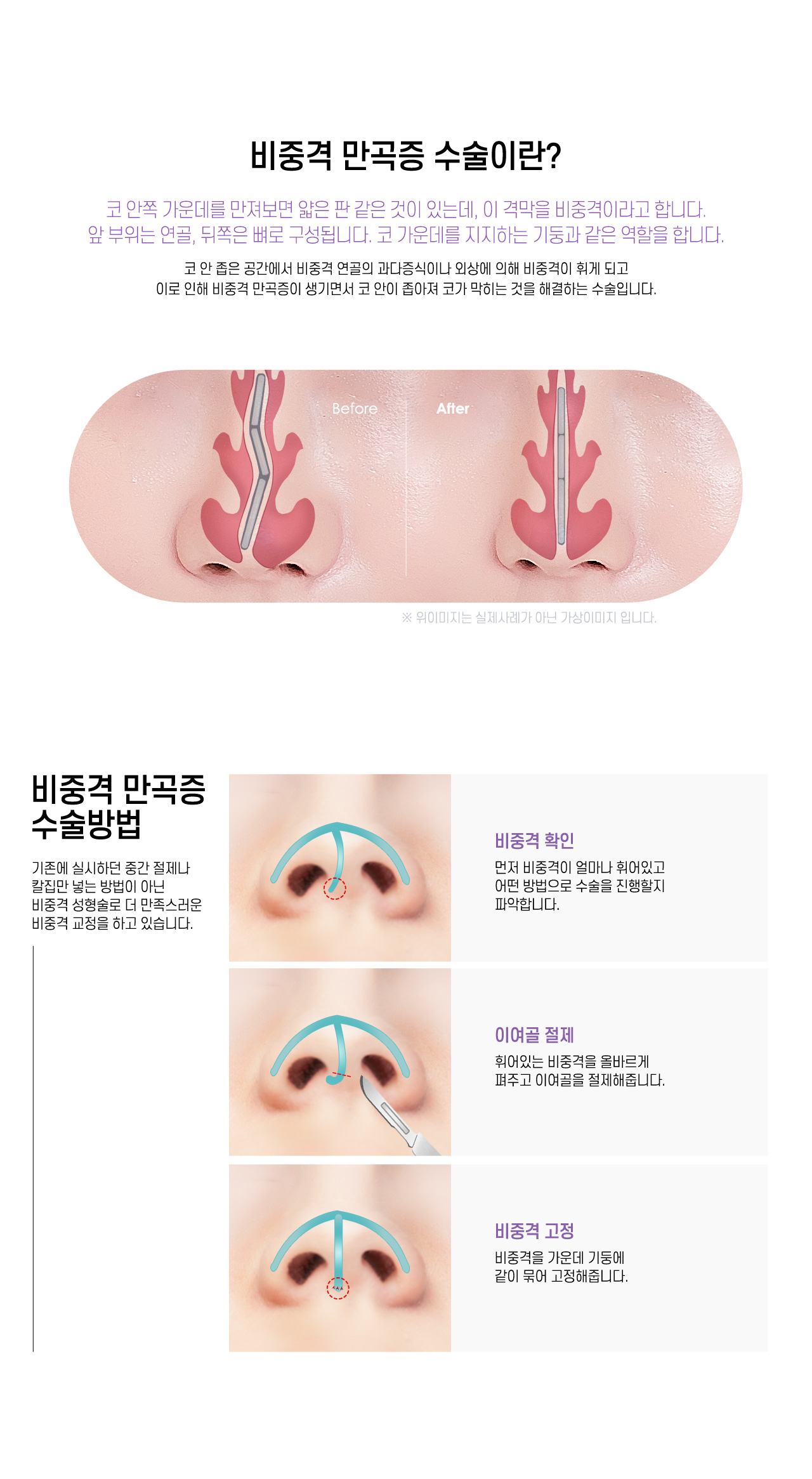 비중격 만곡증 수술이란?