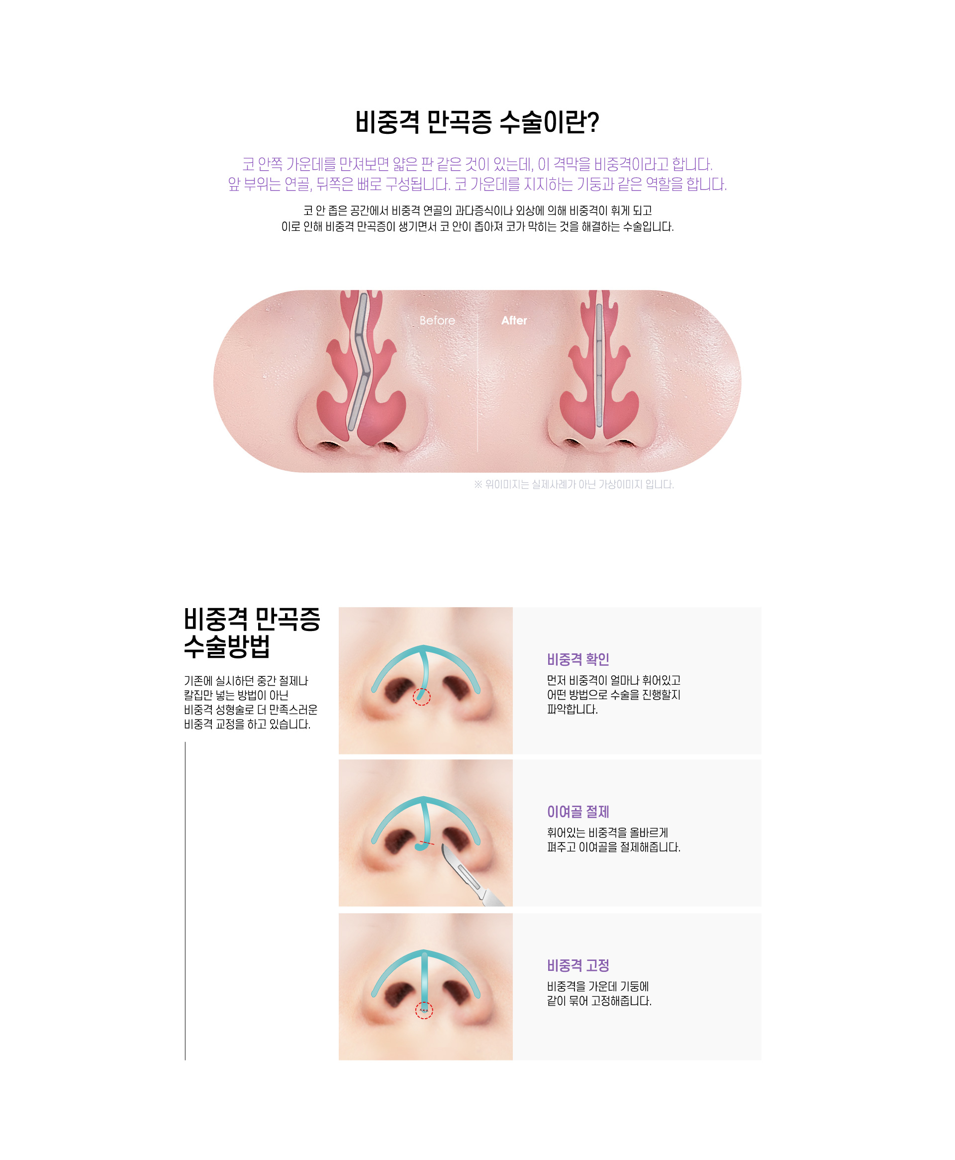 비중격 만곡증 수술이란?