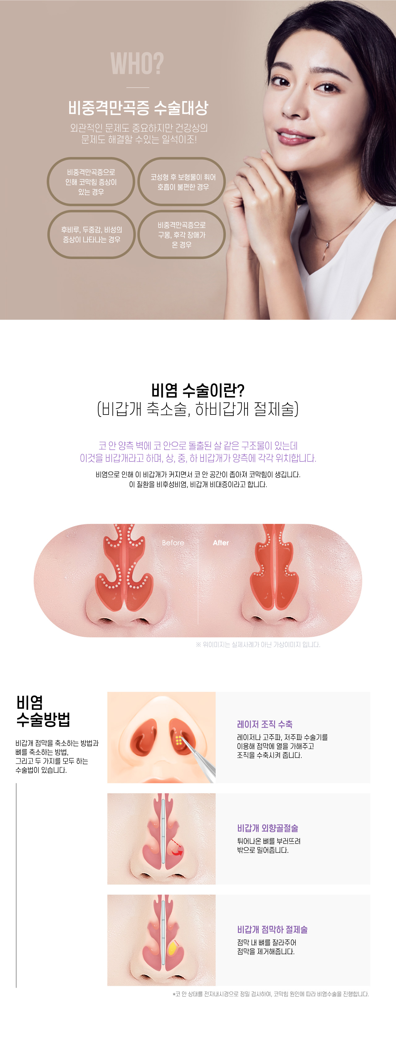 비염수술이란?