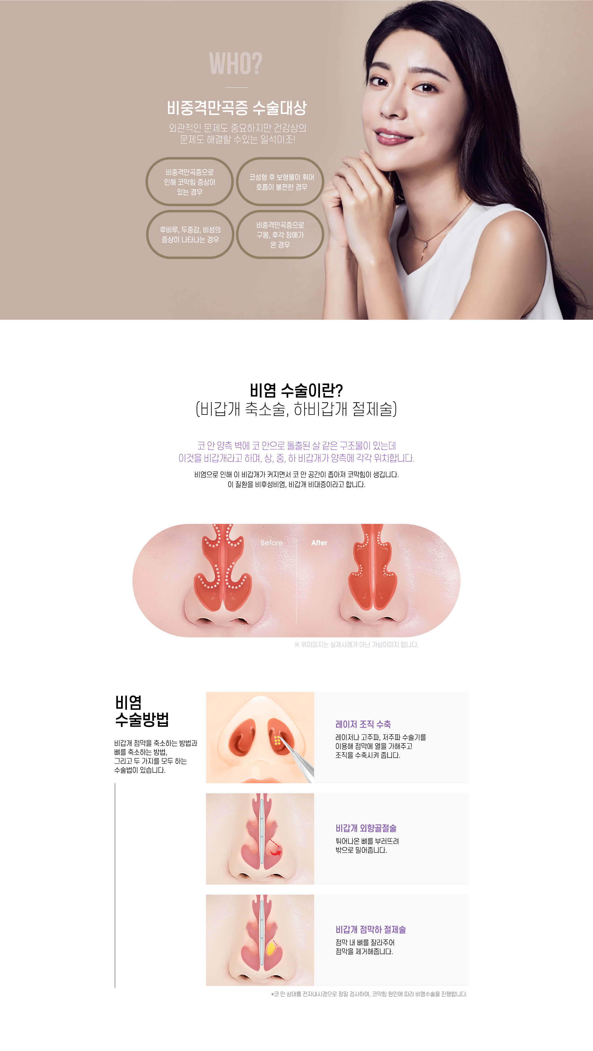 비염수술이란?