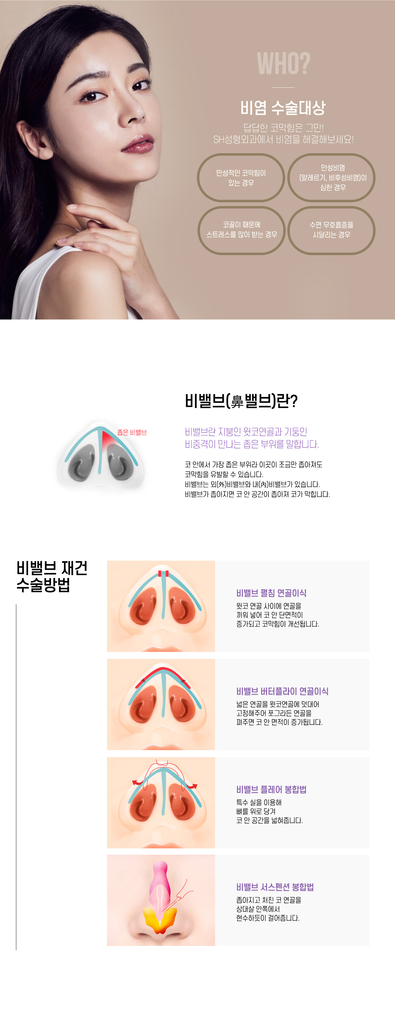 비염수술대상