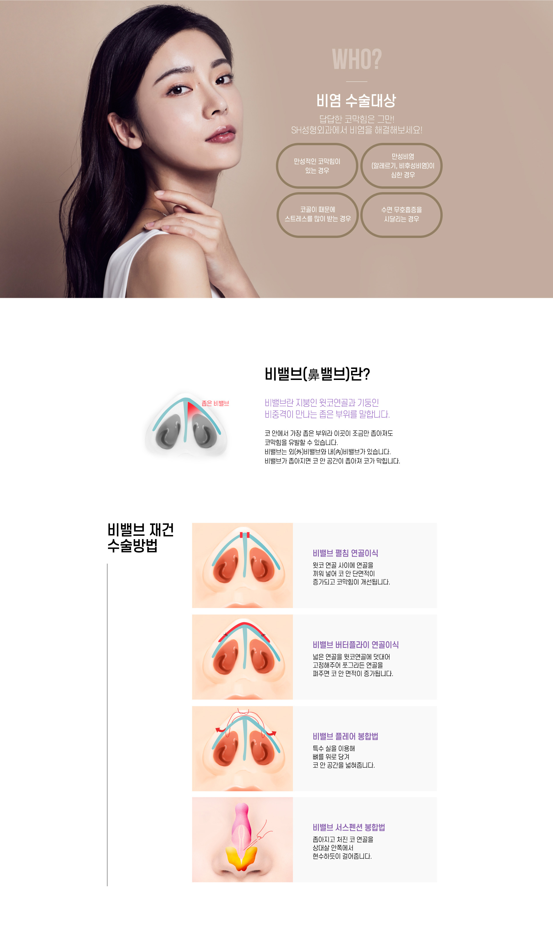비염수술대상