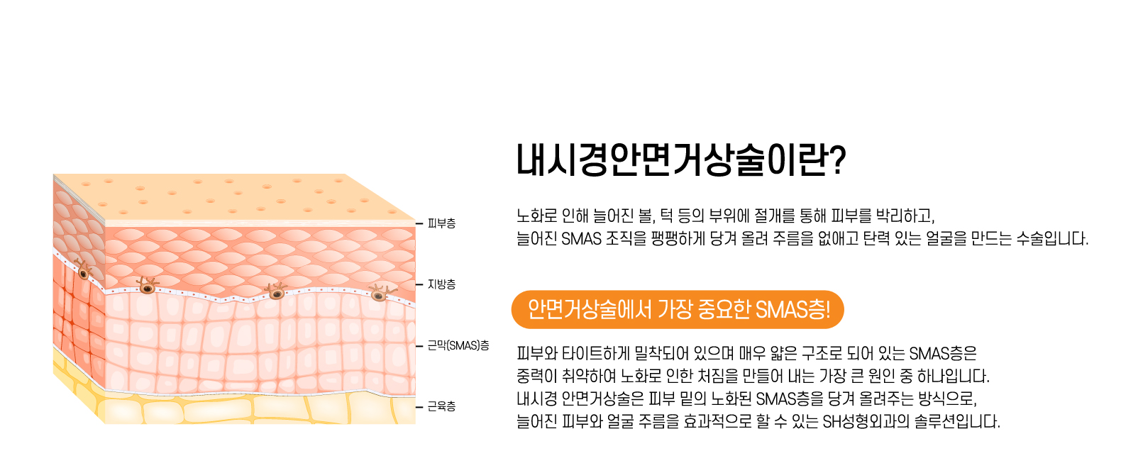내시경안면거상술 이란?