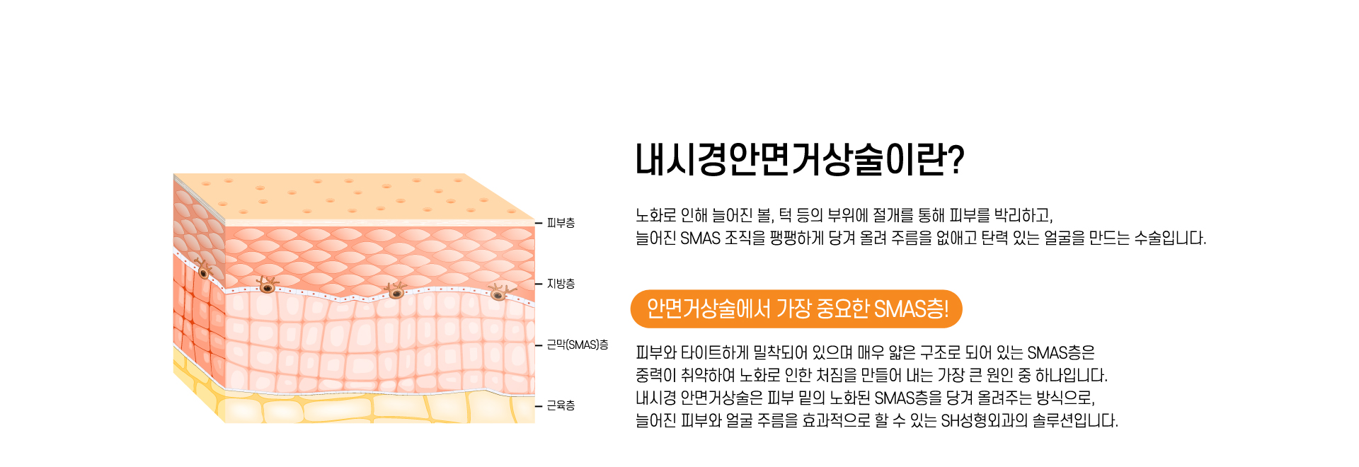 내시경안면거상술 이란?