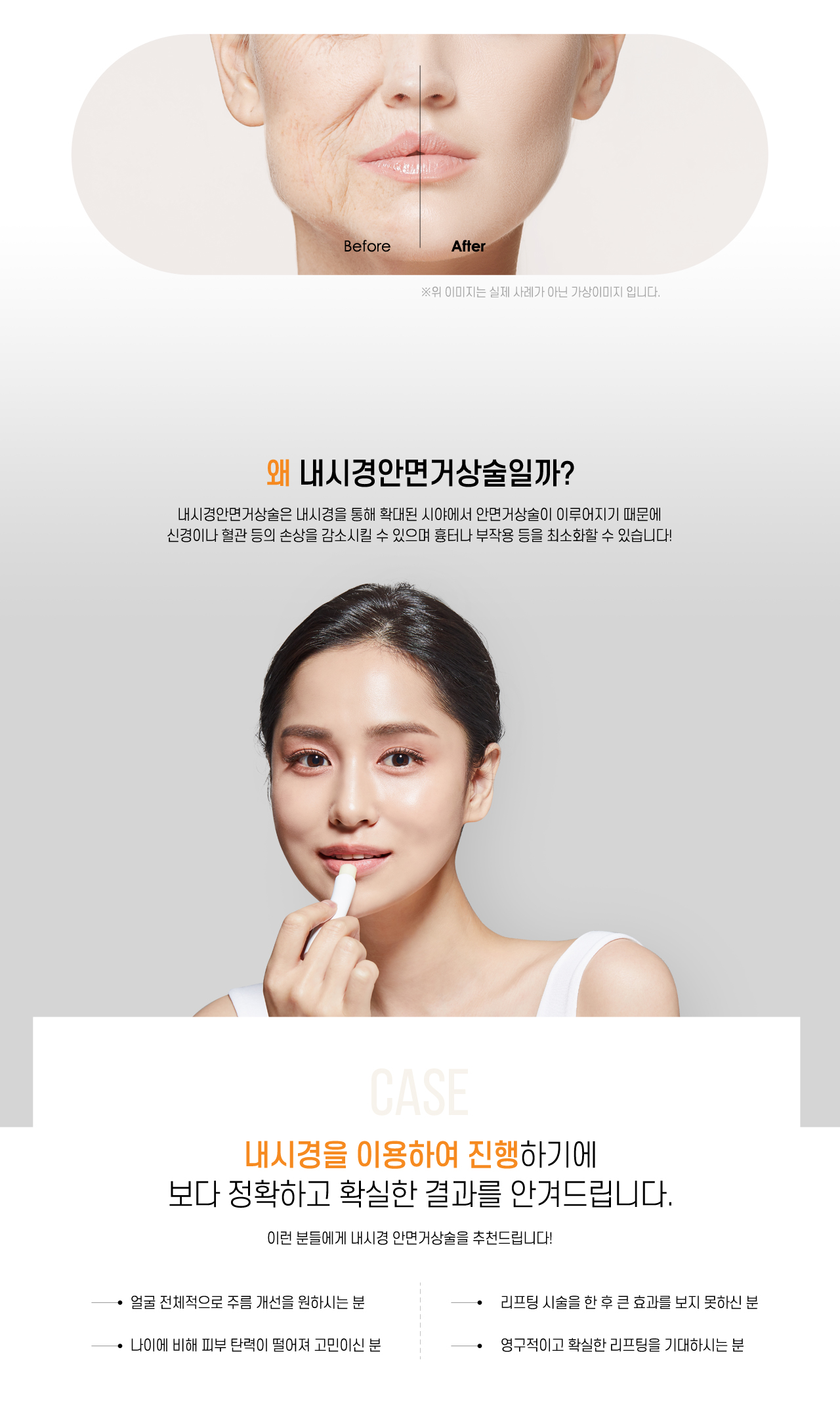 내시경안면거상술 수술방법