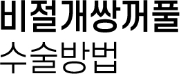 비절개쌍꺼풀 수술방법