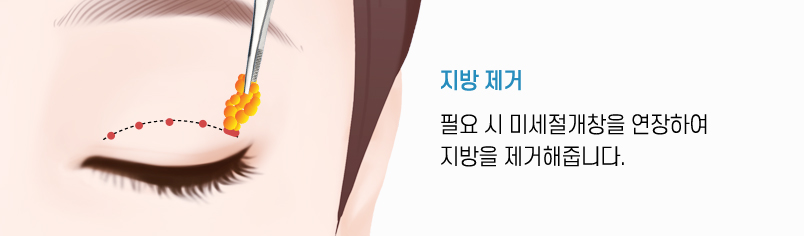 비절개쌍꺼풀 수술방법