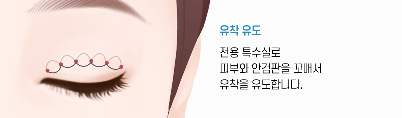 비절개쌍꺼풀 수술방법
