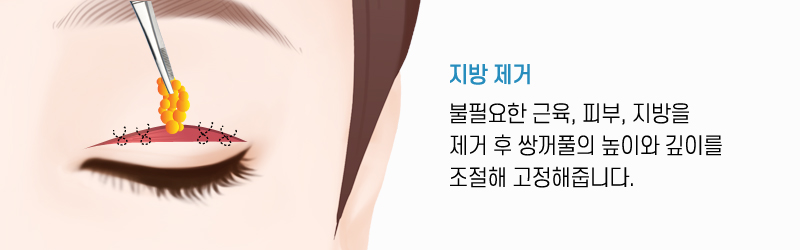 절개쌍꺼풀 수술방법